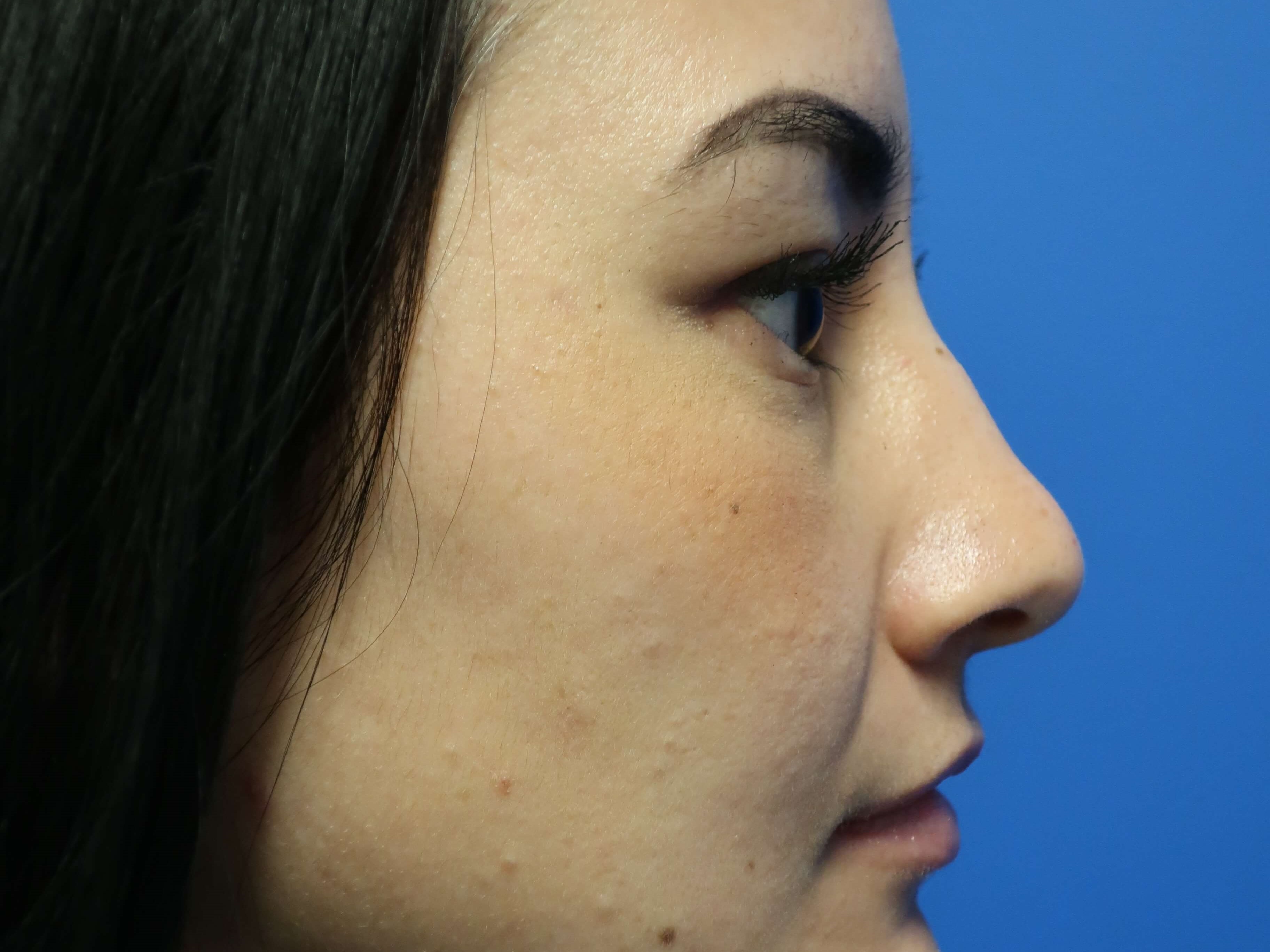 JUVEDERM Rhinoplasty After