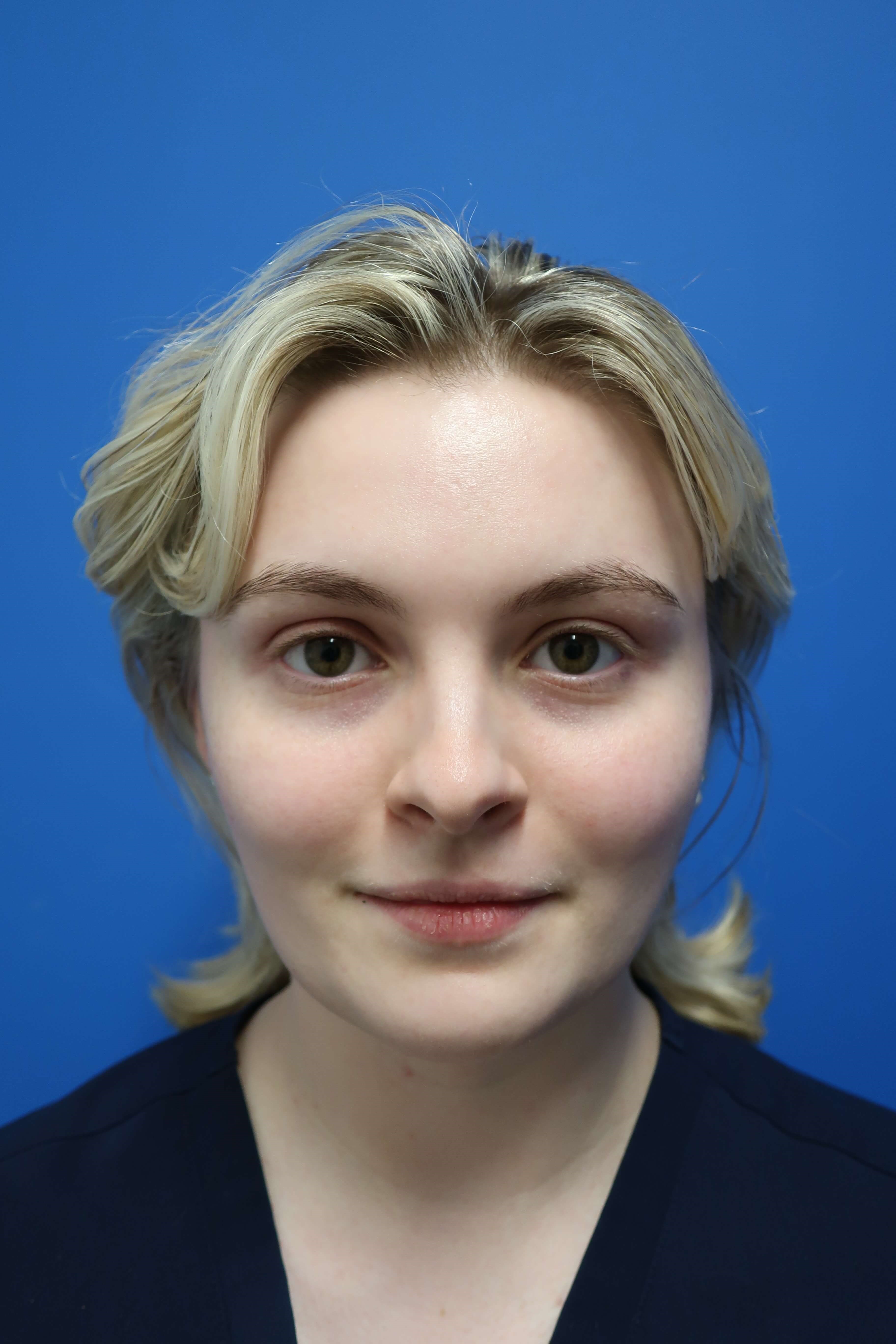 JUVEDERM Rhinoplasty Before