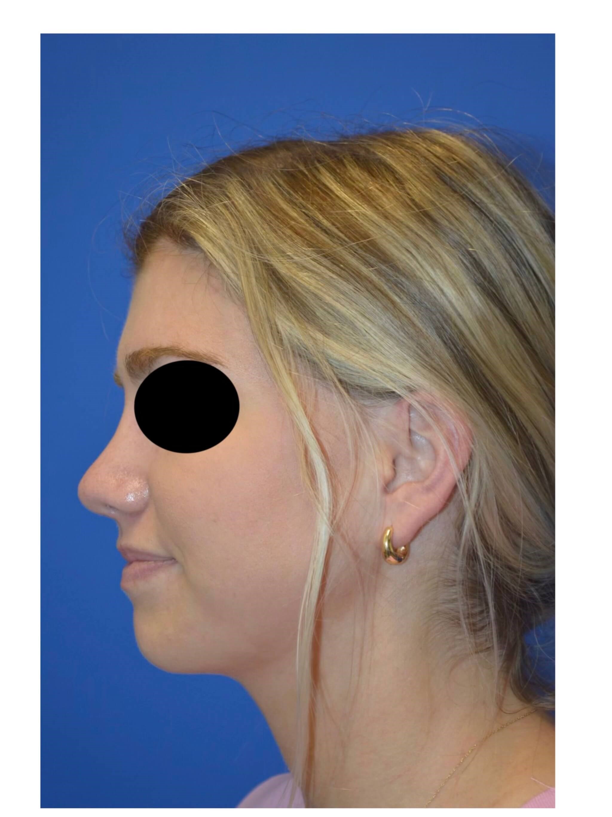 Rhinoplasty After
