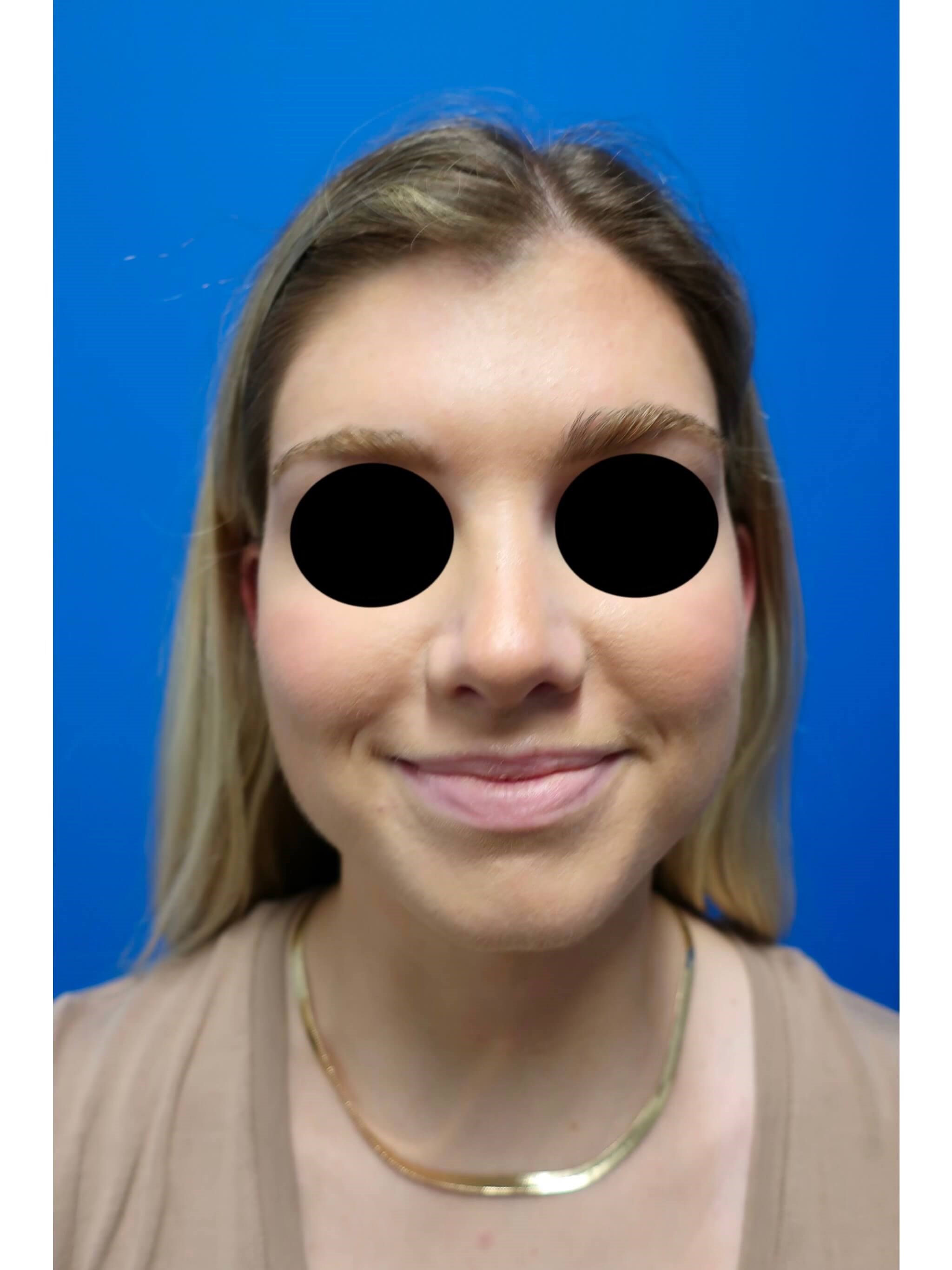 Rhinoplasty Before