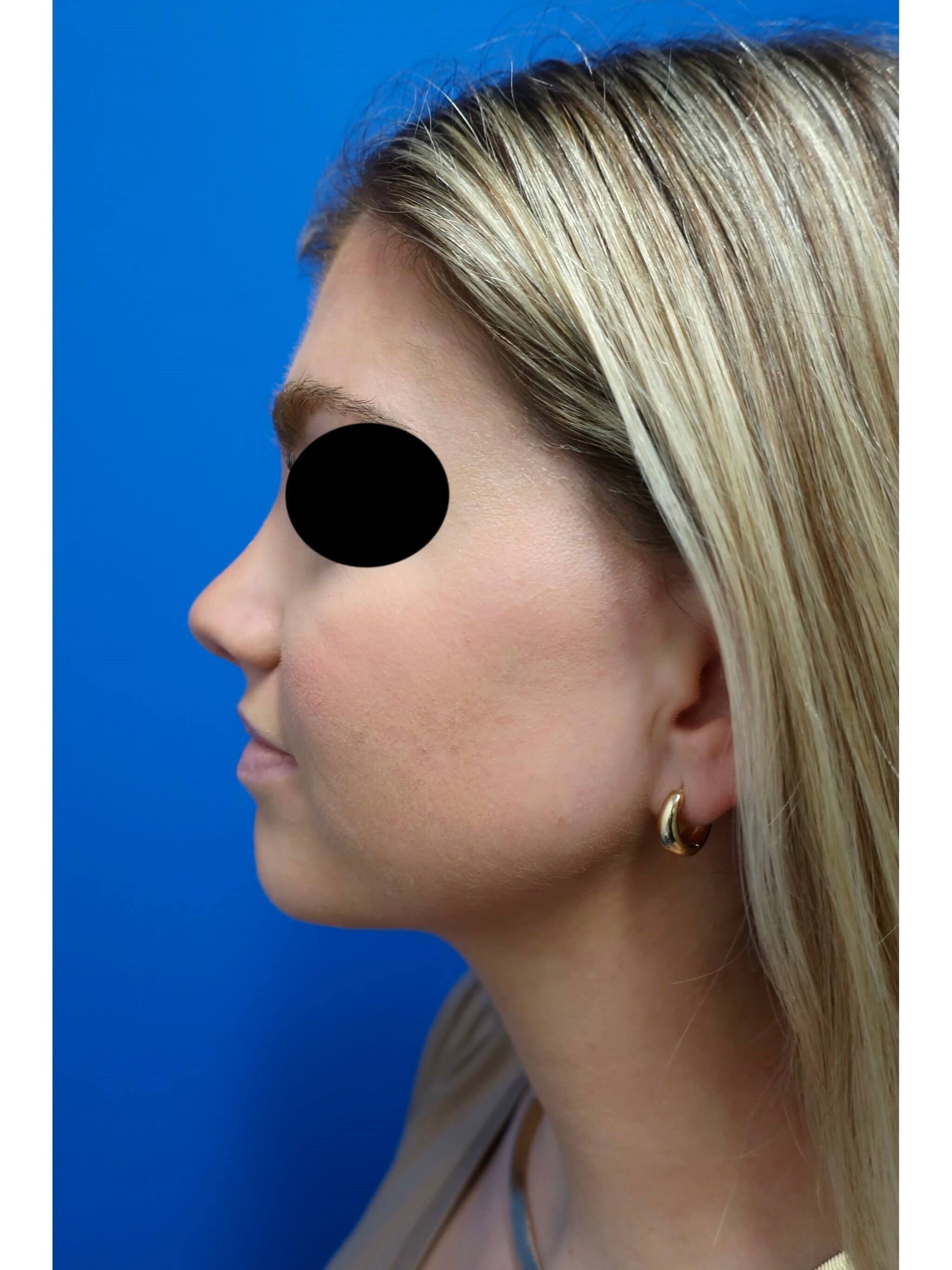Rhinoplasty After