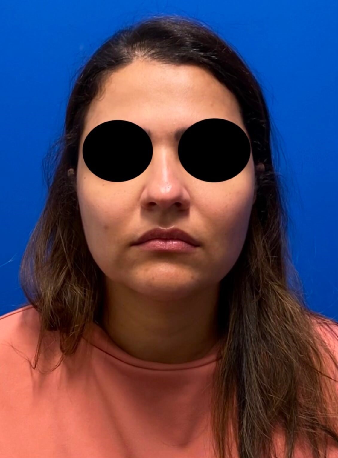 Rhinoplasty Before