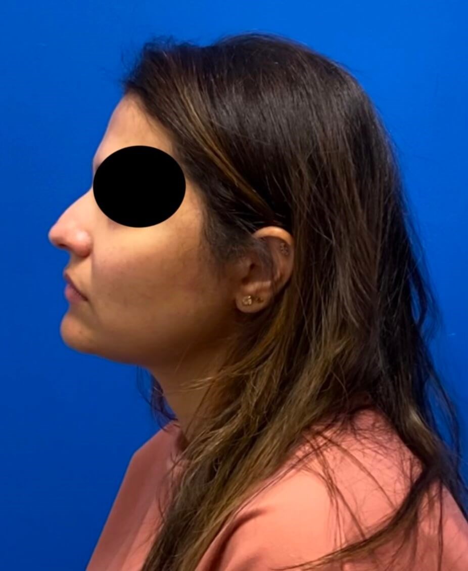 Rhinoplasty After