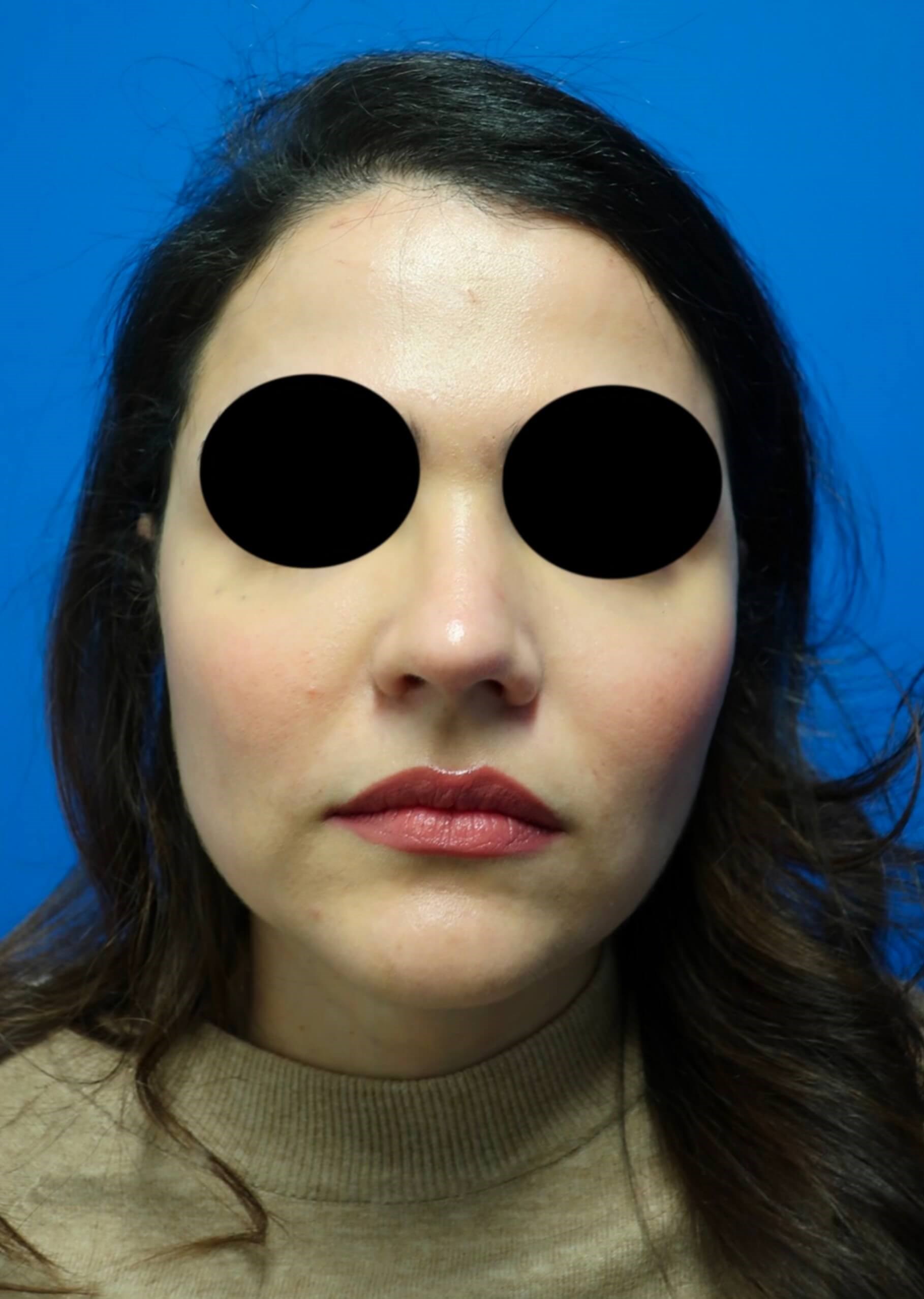 Rhinoplasty Before