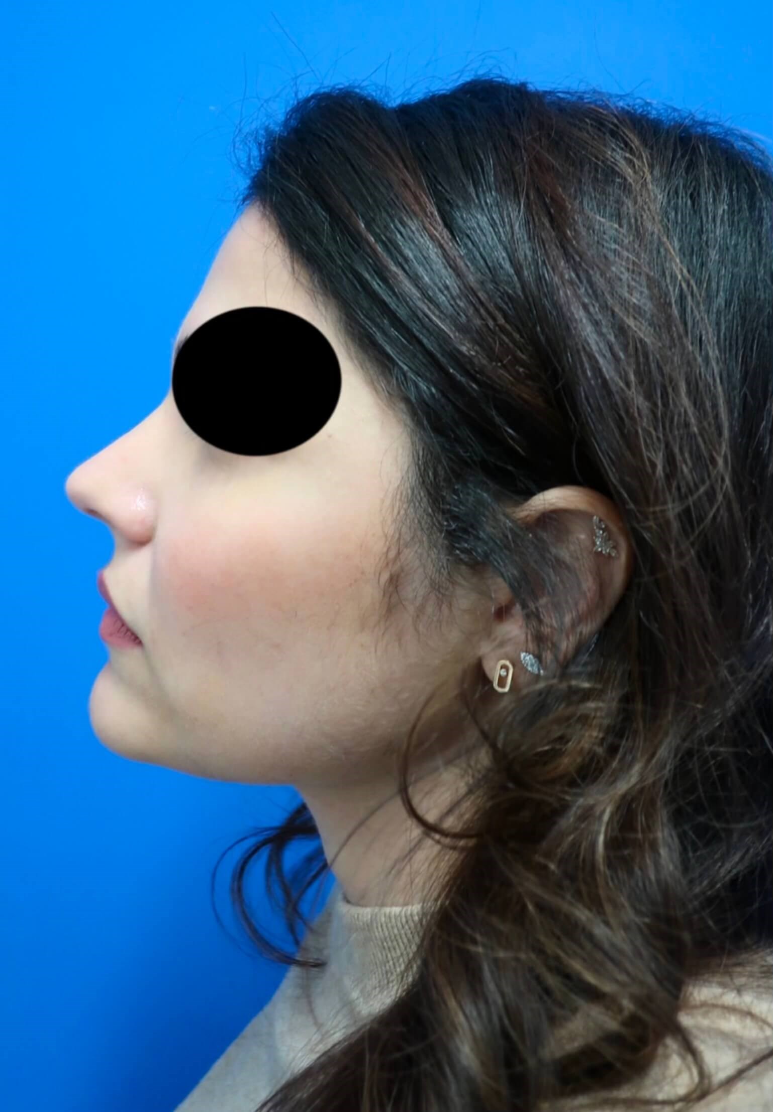 Rhinoplasty After