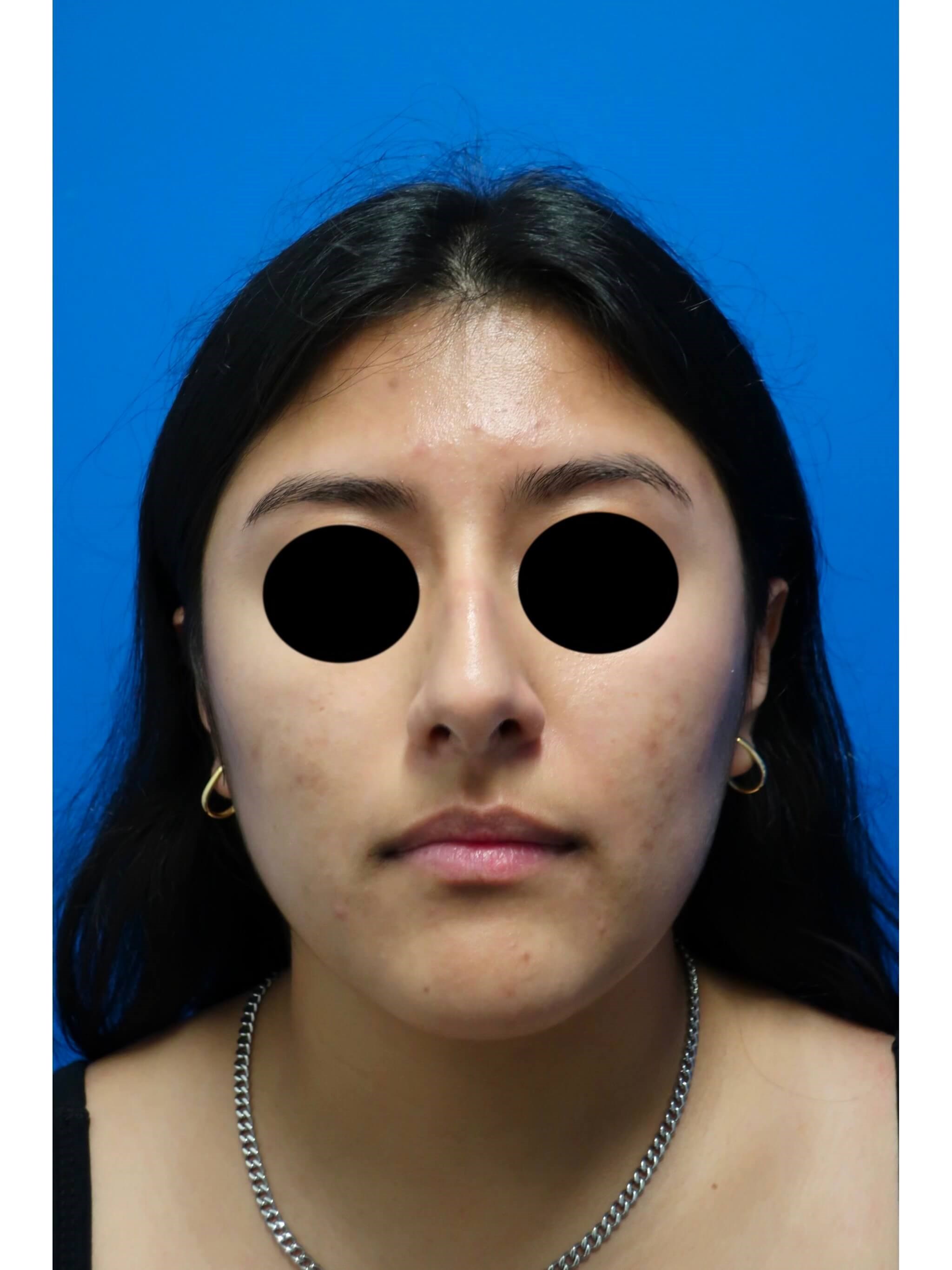Rhinoplasty Before