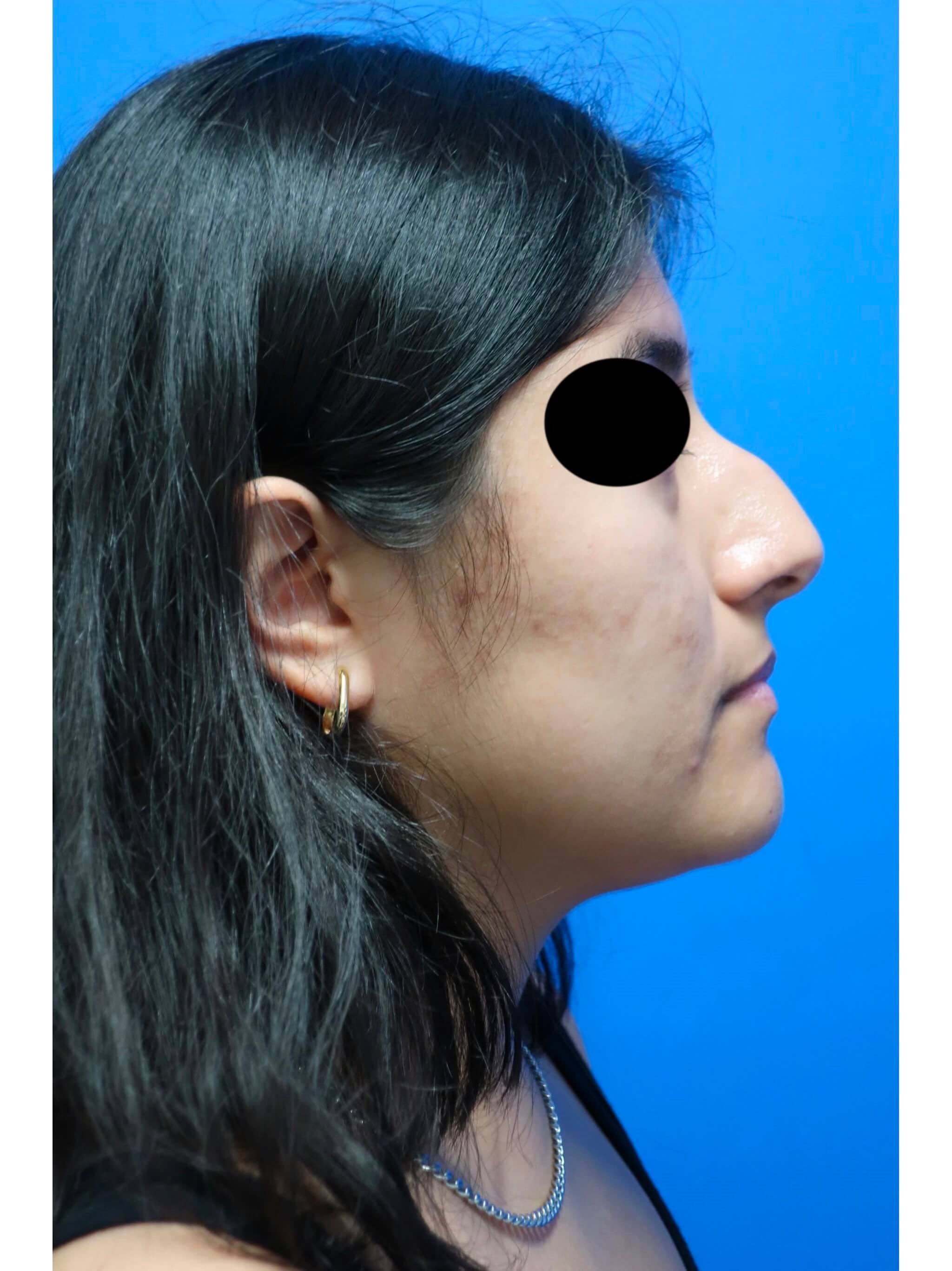 Rhinoplasty After
