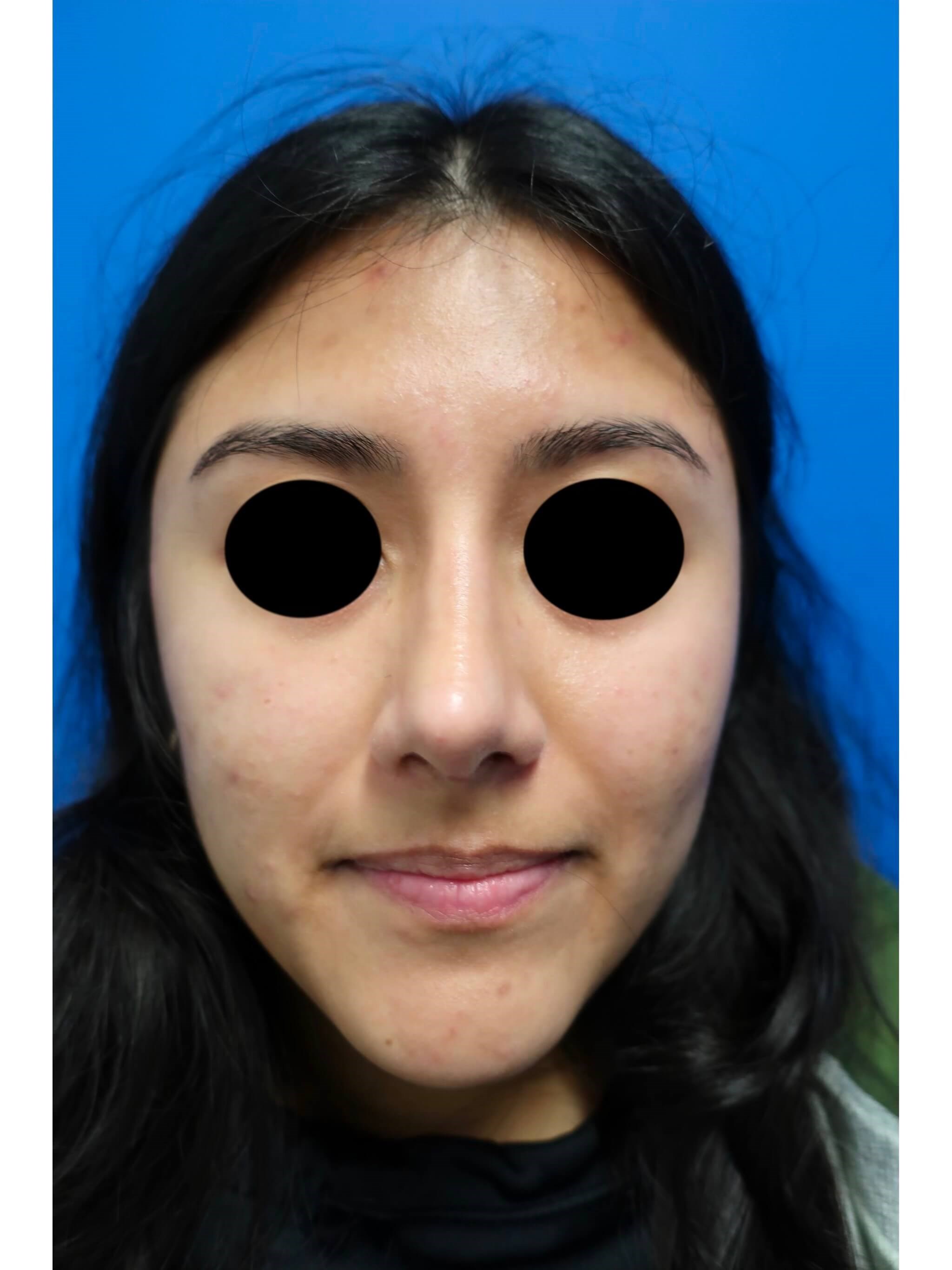 Rhinoplasty Before