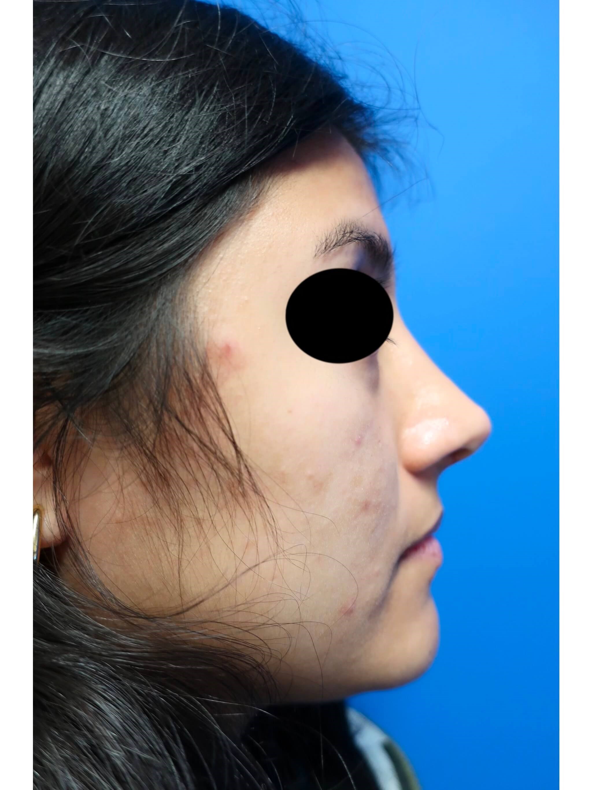 Rhinoplasty After