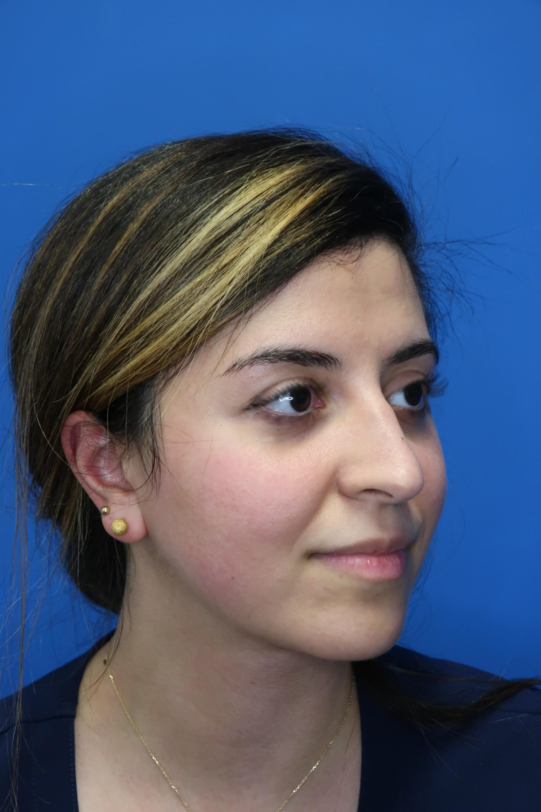 Rhinoplasty Profile Before