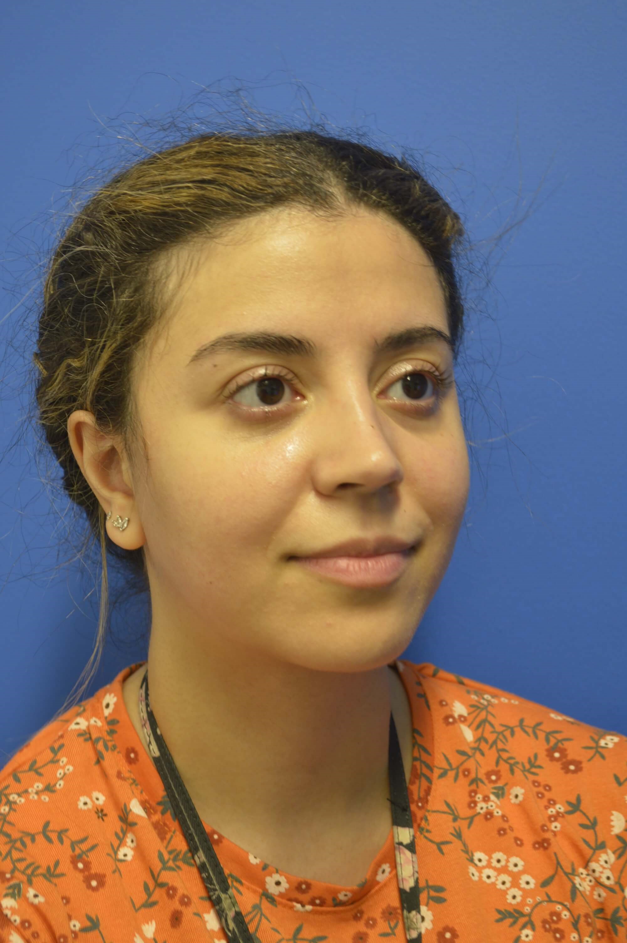 Rhinoplasty Profile After