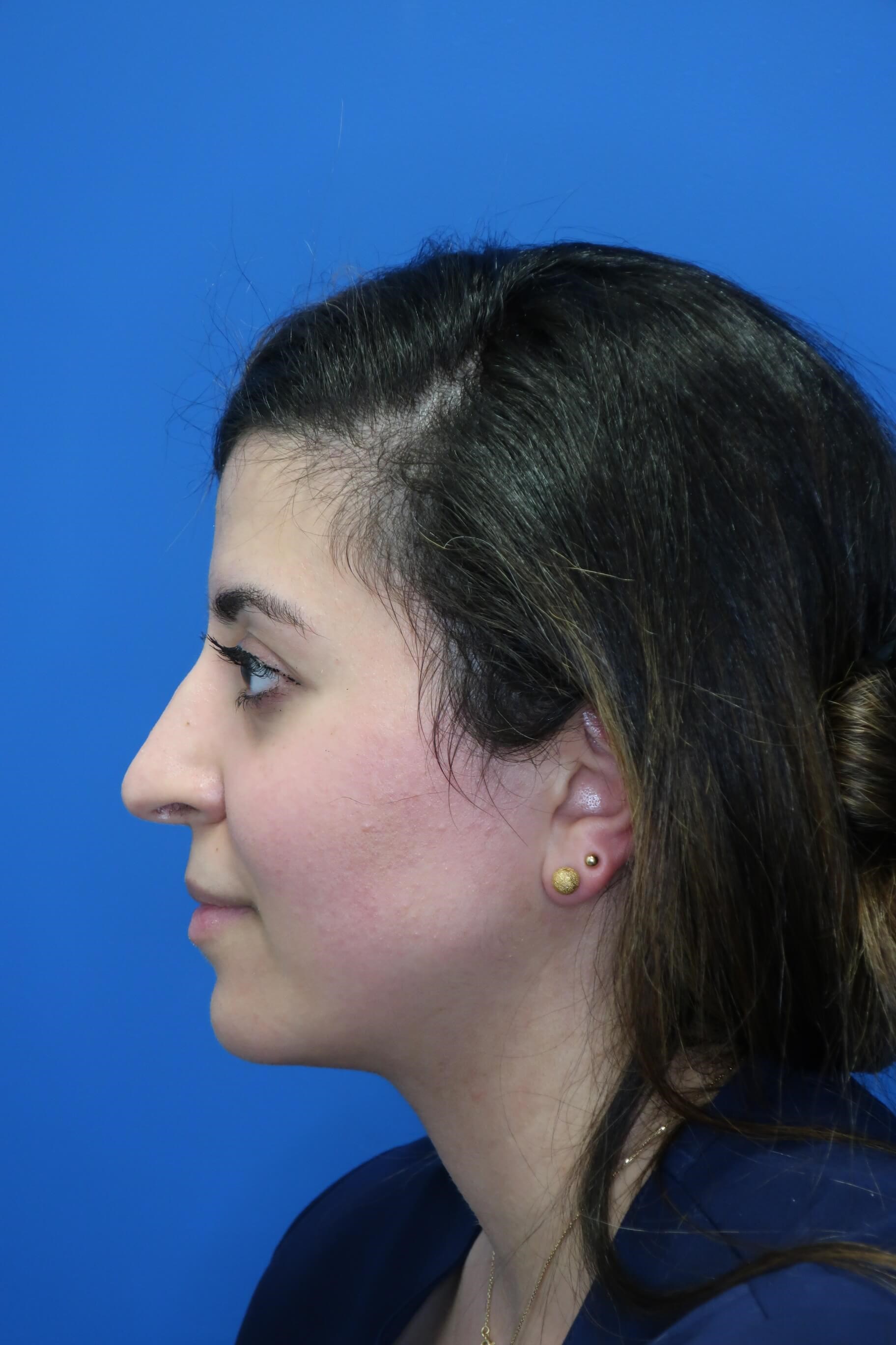 Rhinoplasty Profile Before