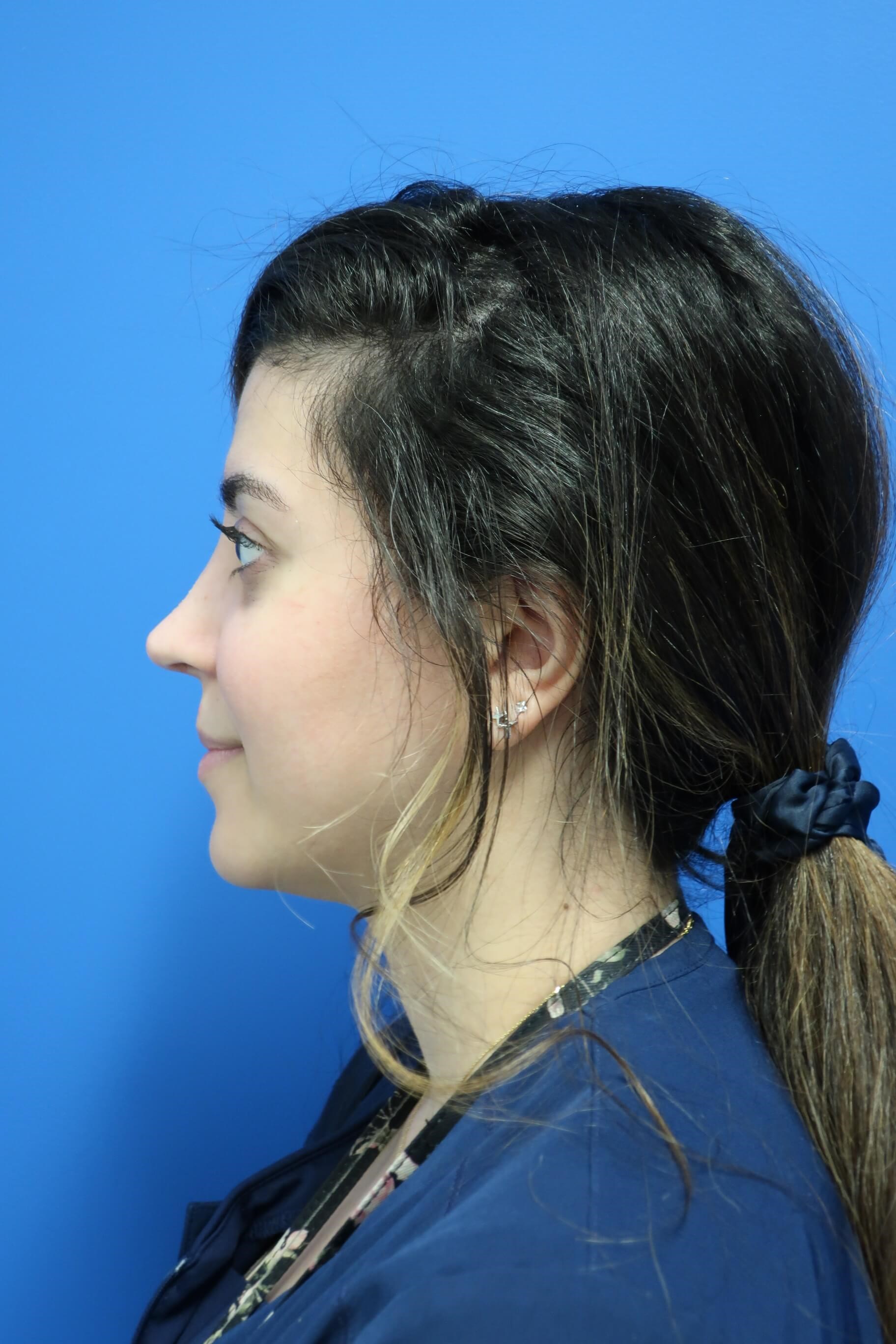 Rhinoplasty Profile After