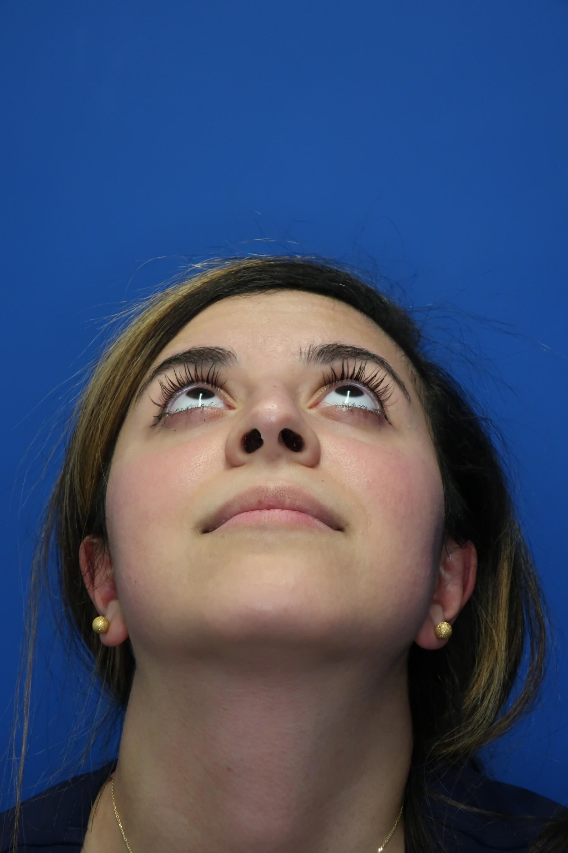 Rhinoplasty Before