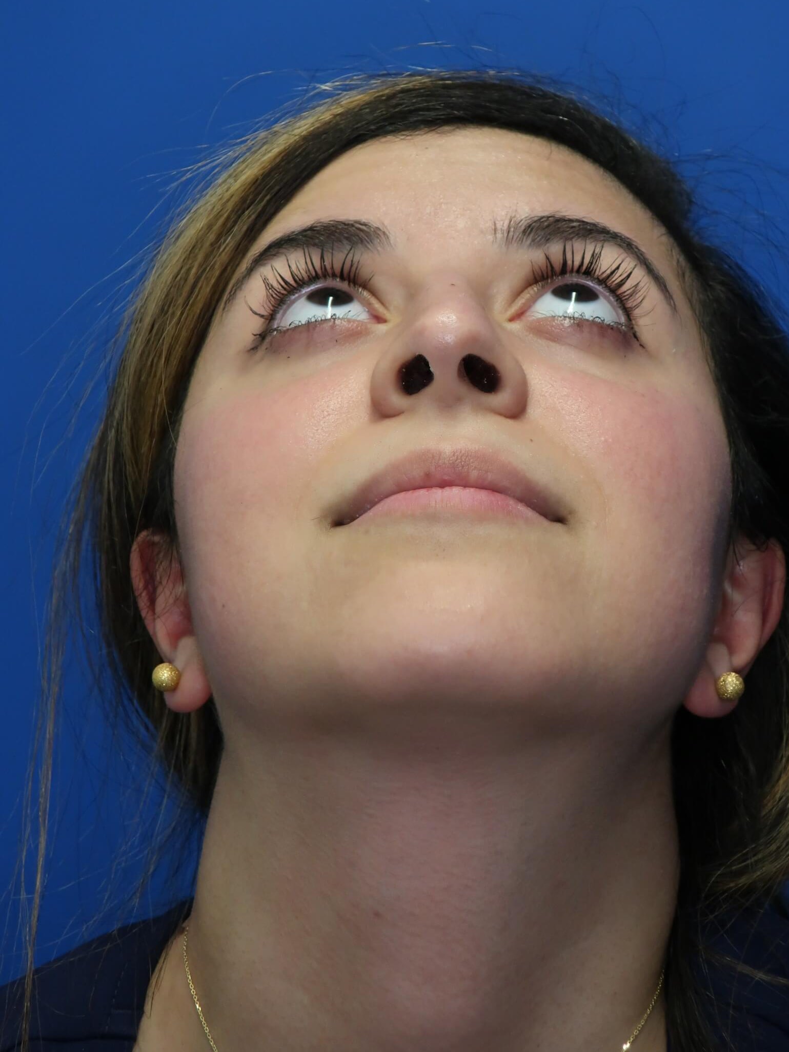 Rhinoplasty Before