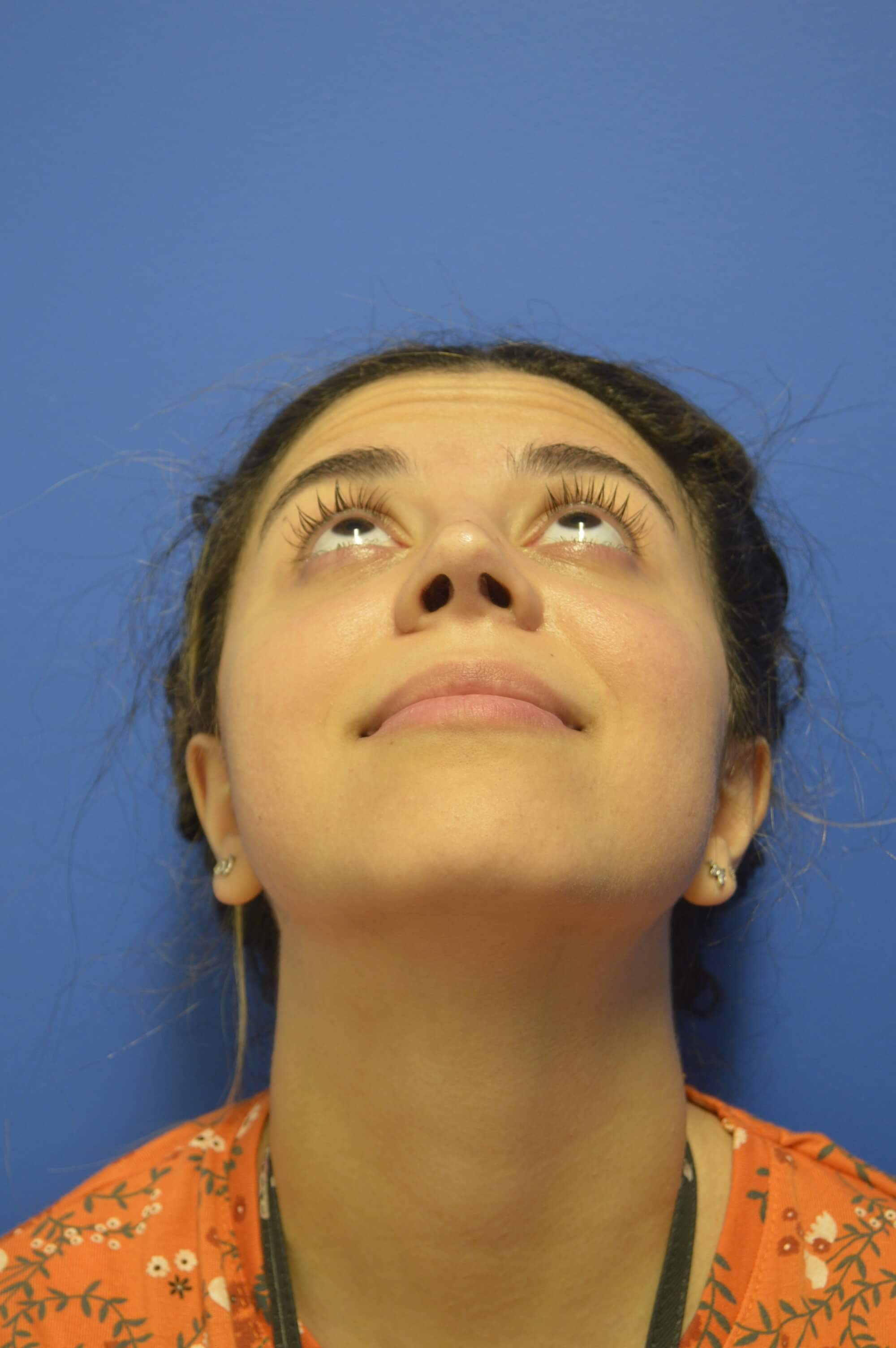 Rhinoplasty After