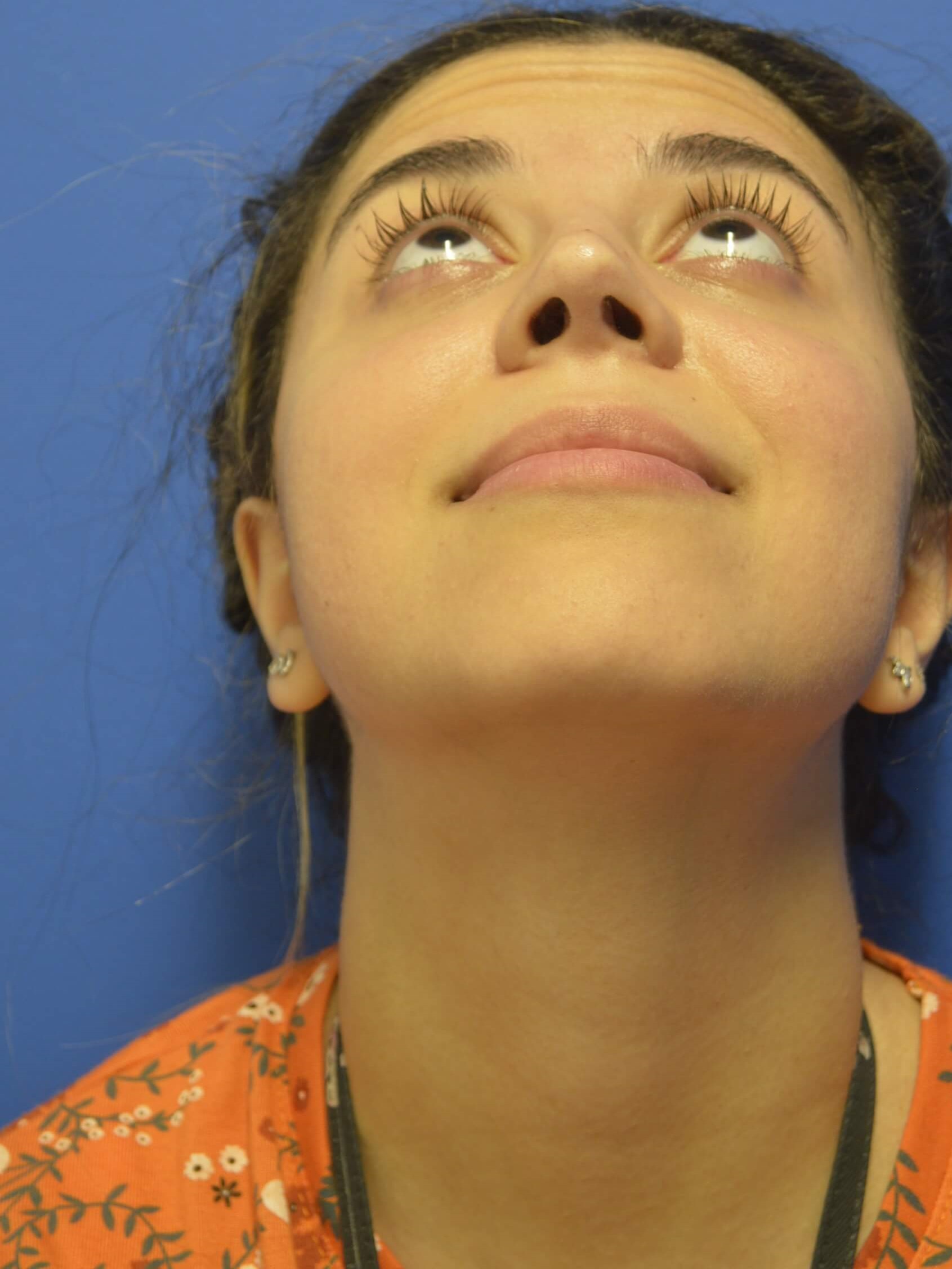 Rhinoplasty After