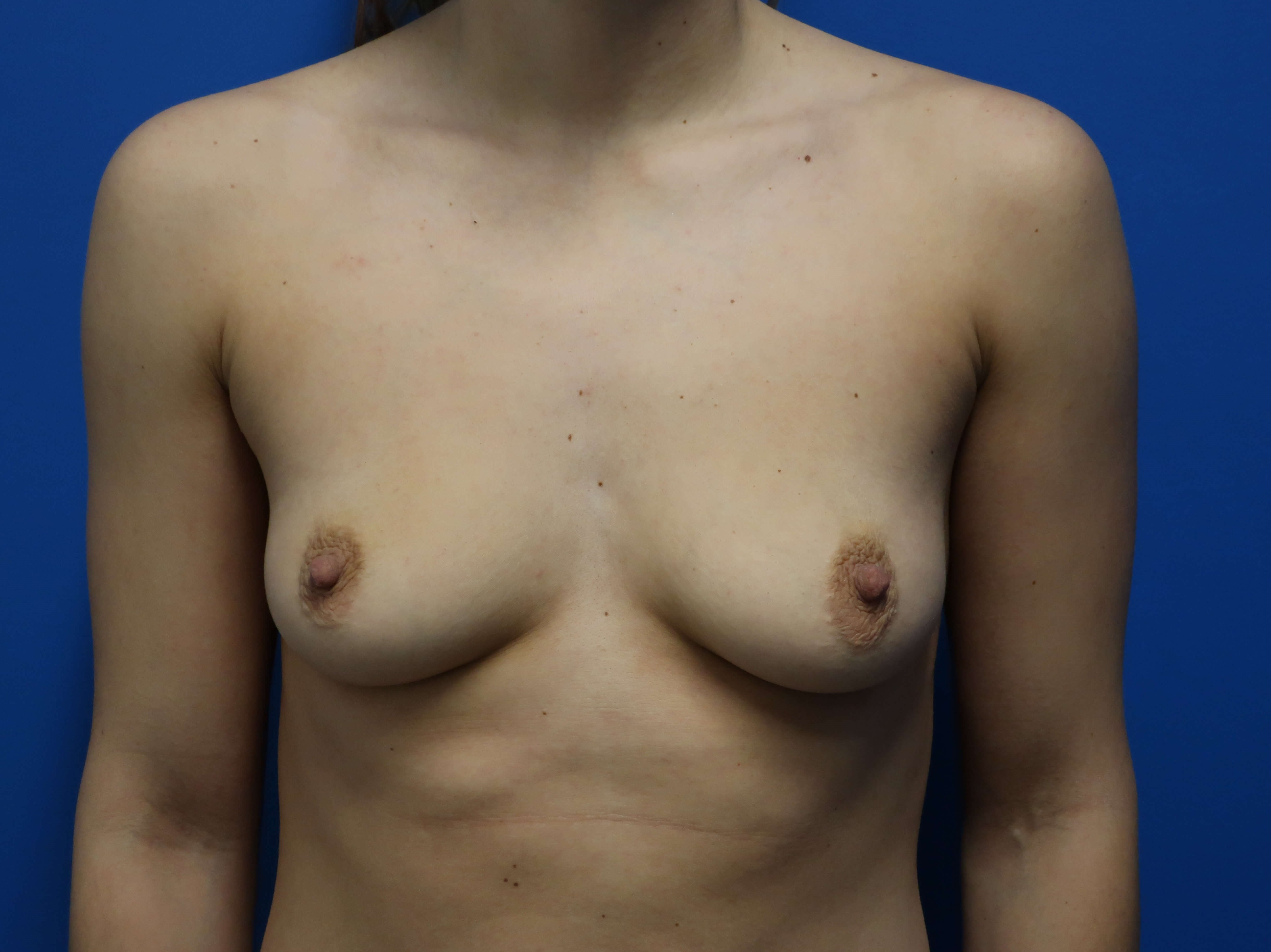 Breast Augmentation Before
