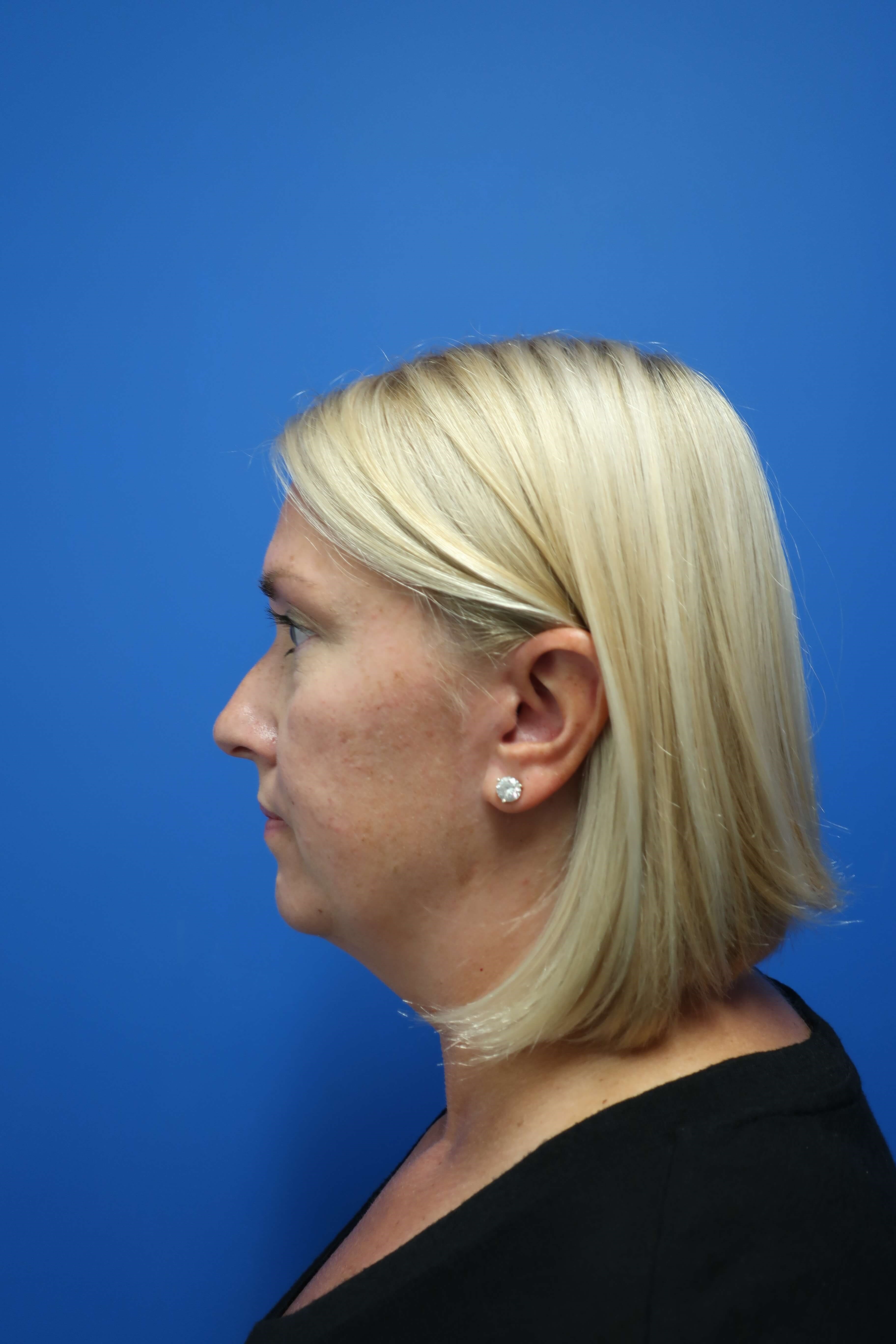 Vaser liposuction of the neck Before