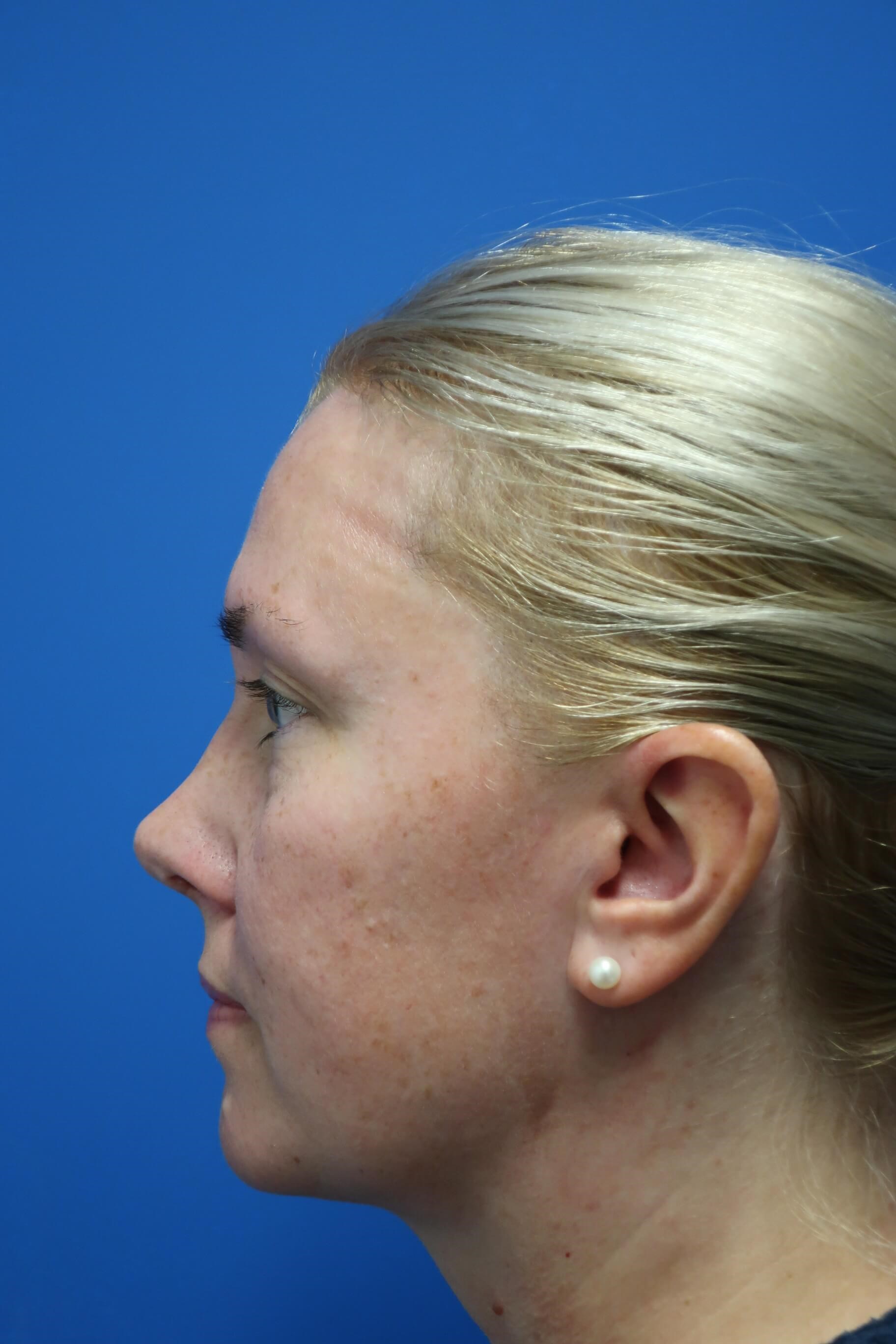 Vaser liposuction of the neck After