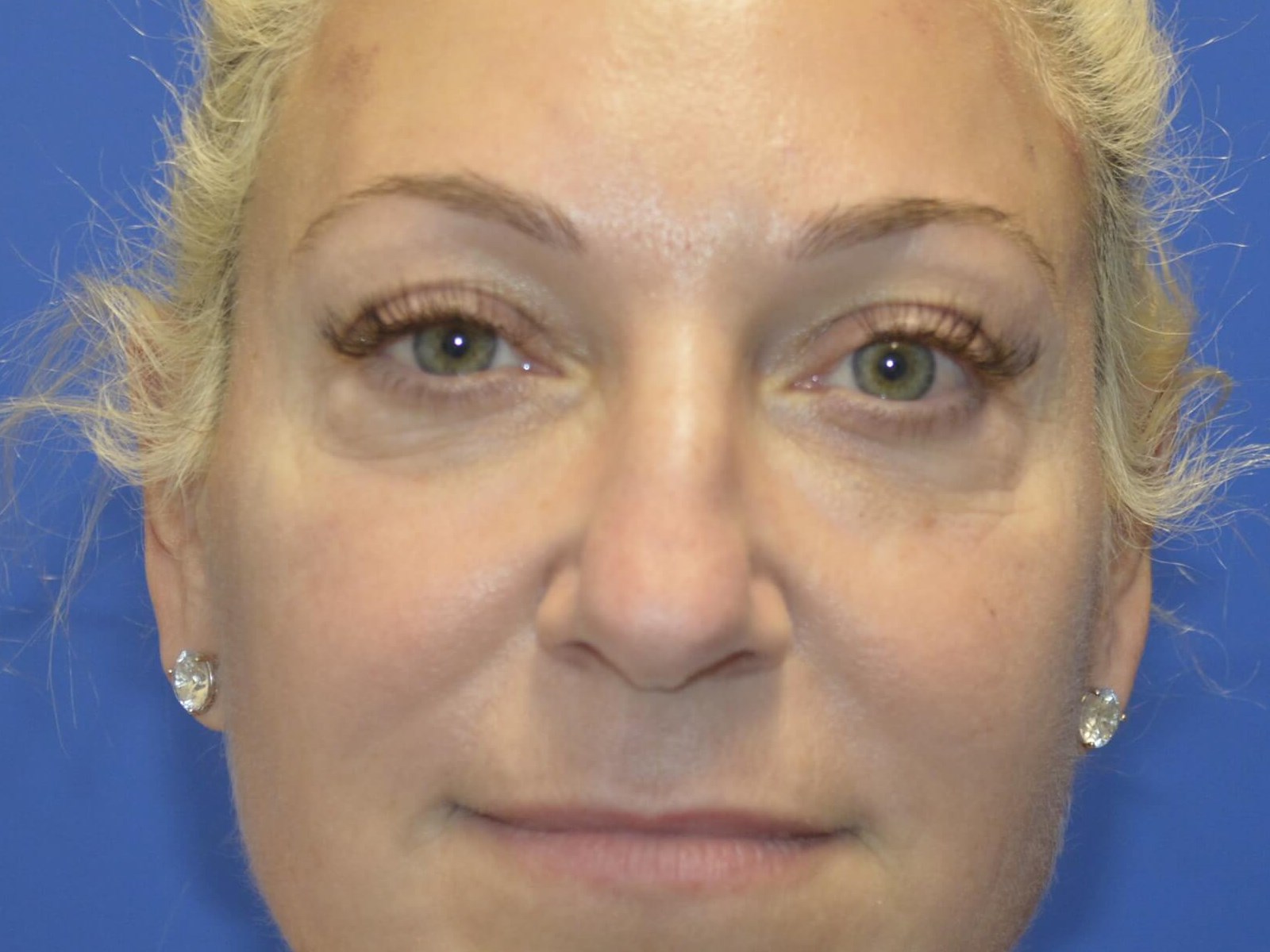 Lower Blepharoplasty Before