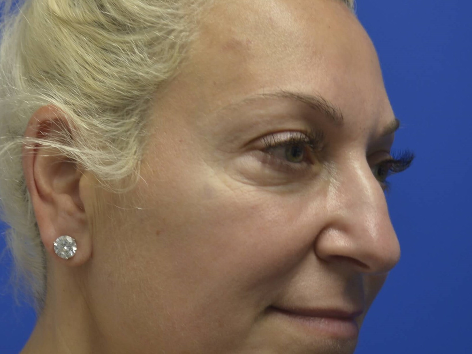 Lower Blepharoplasty Before