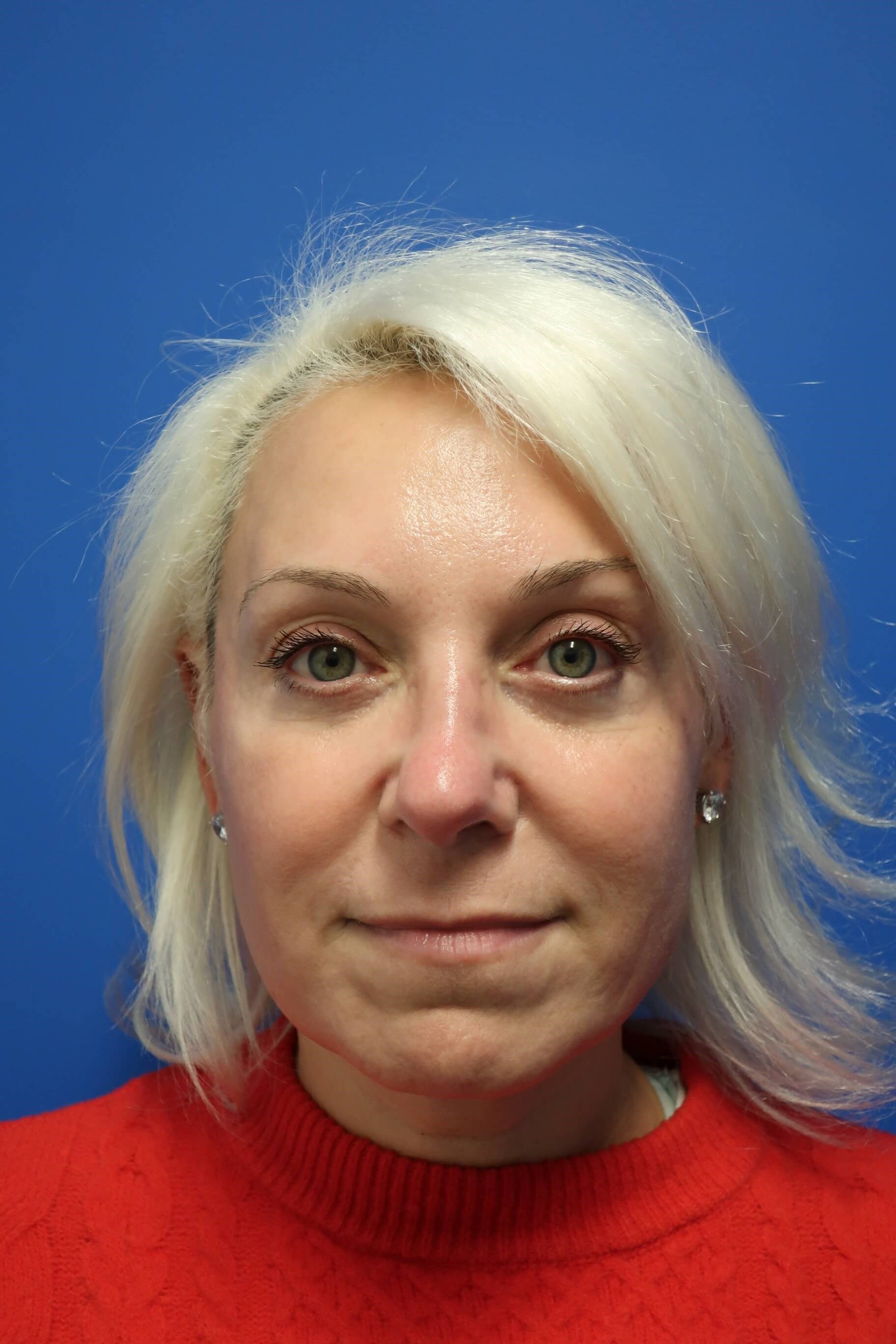 Lower Lid Blepharoplasty After