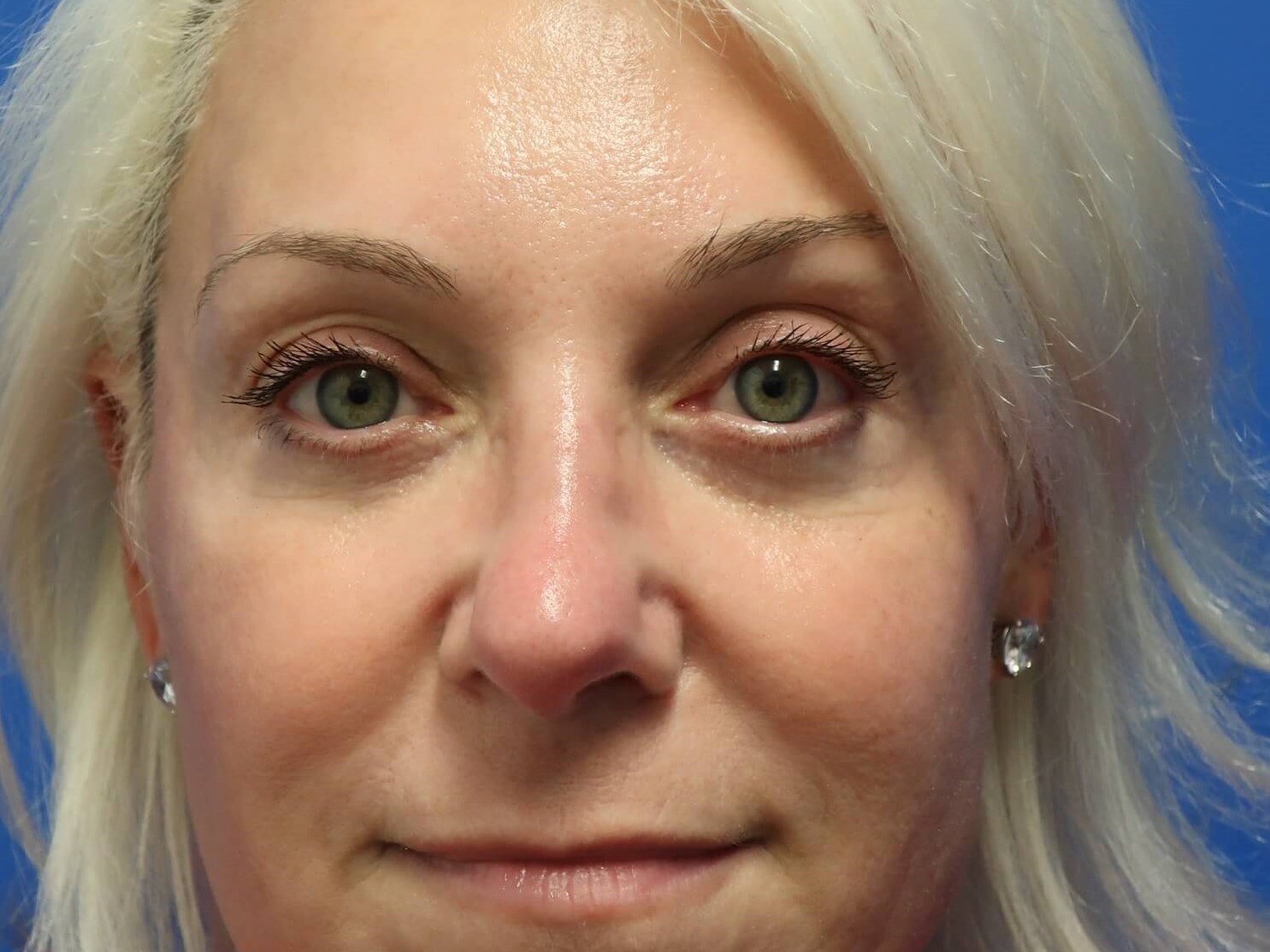 Lower Lid Blepharoplasty After