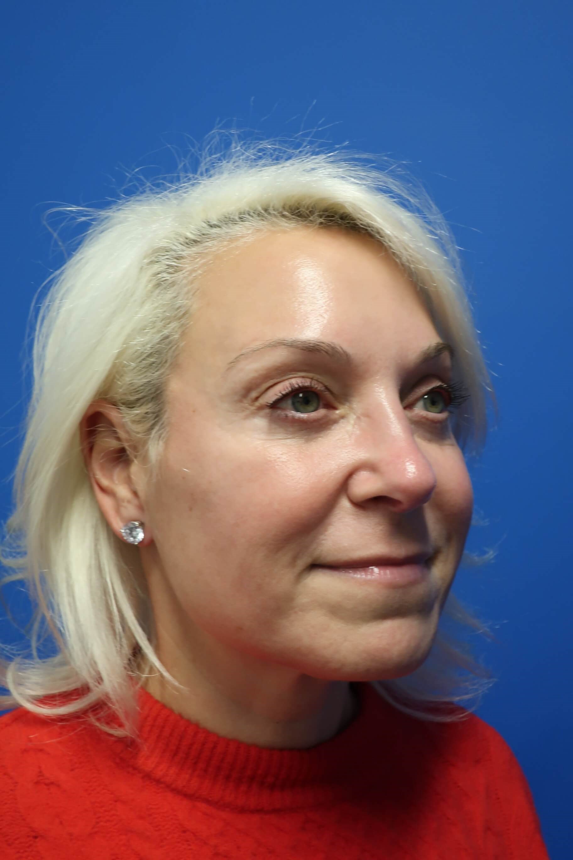 Lower Lid Blepharoplasty After