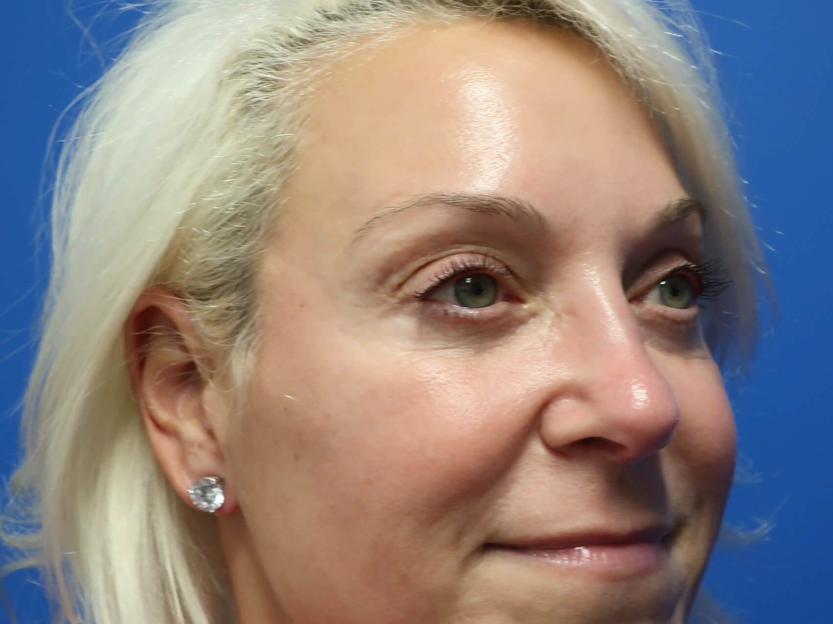Lower Lid Blepharoplasty After