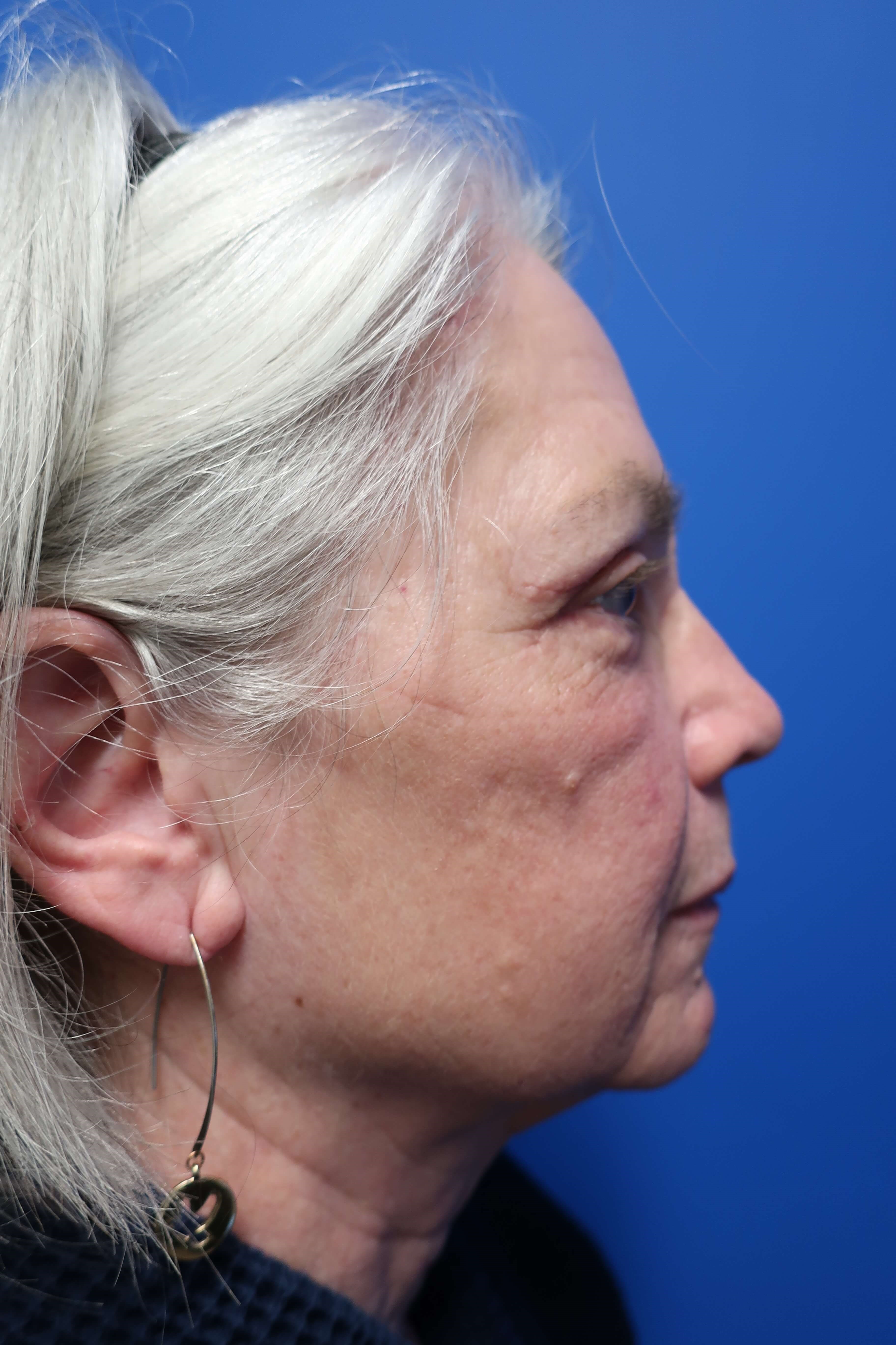 Mid-face Rejuvenation After