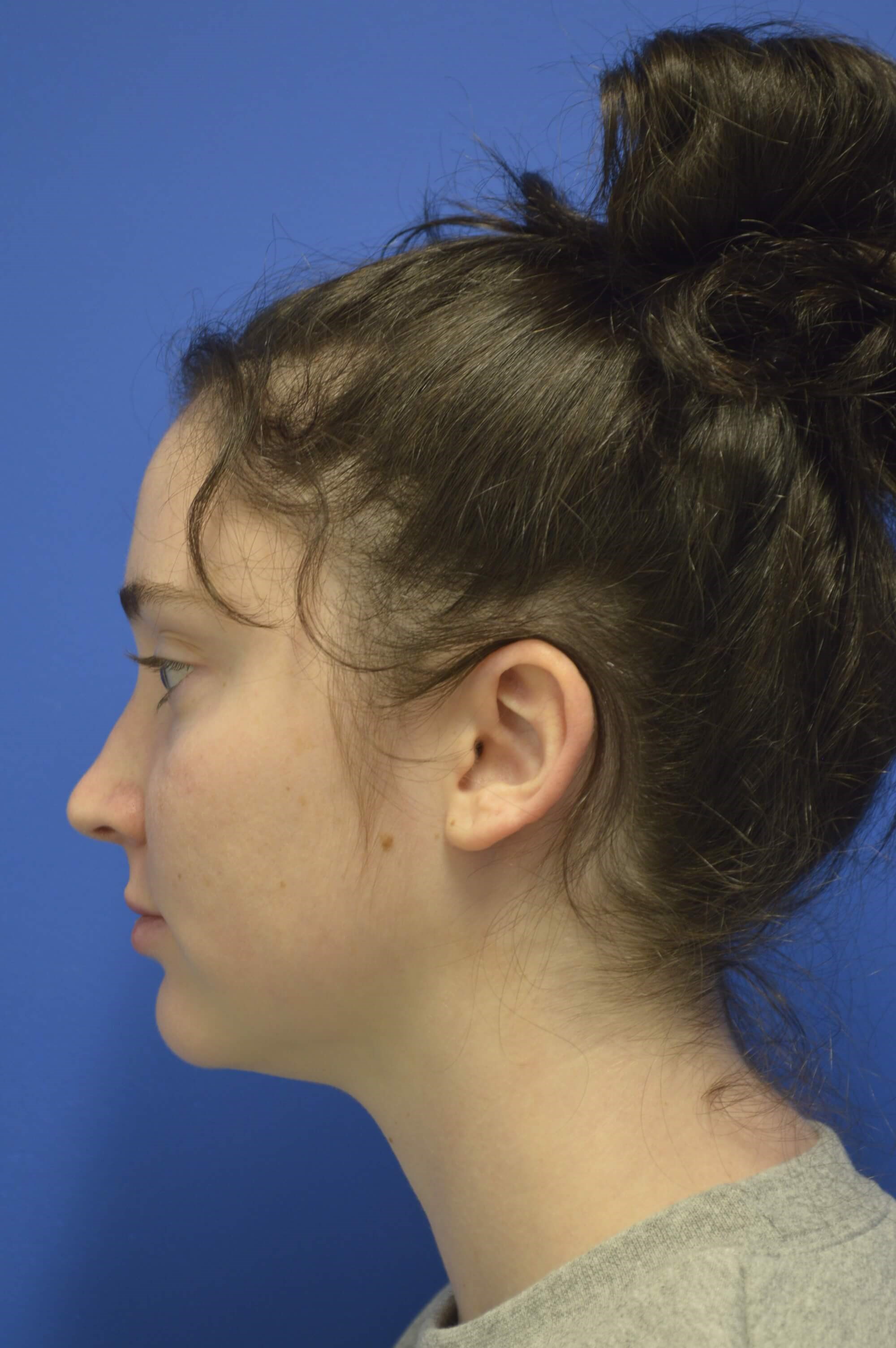 Closed rhinoplasty. Before