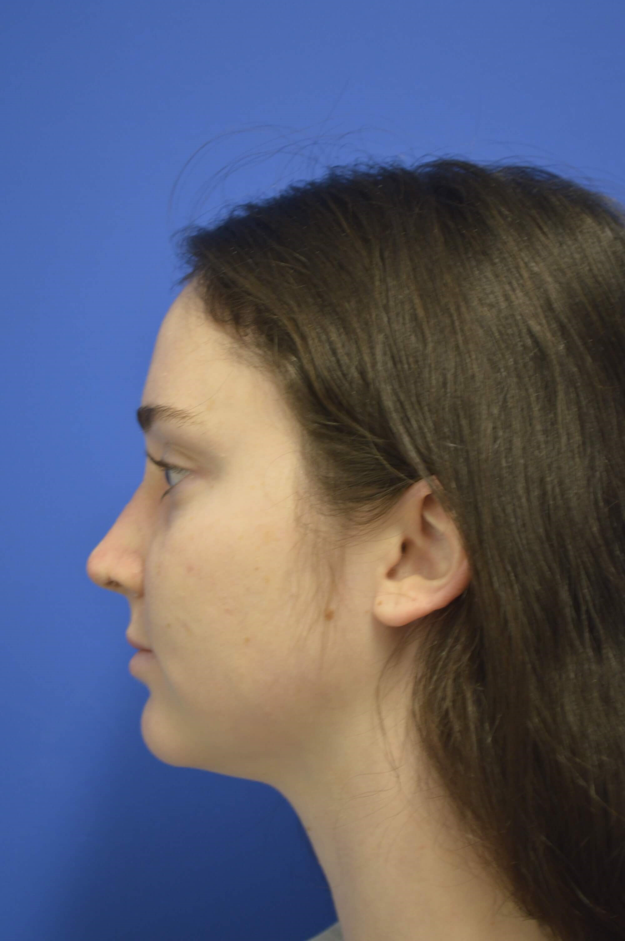 Closed rhinoplasty. After