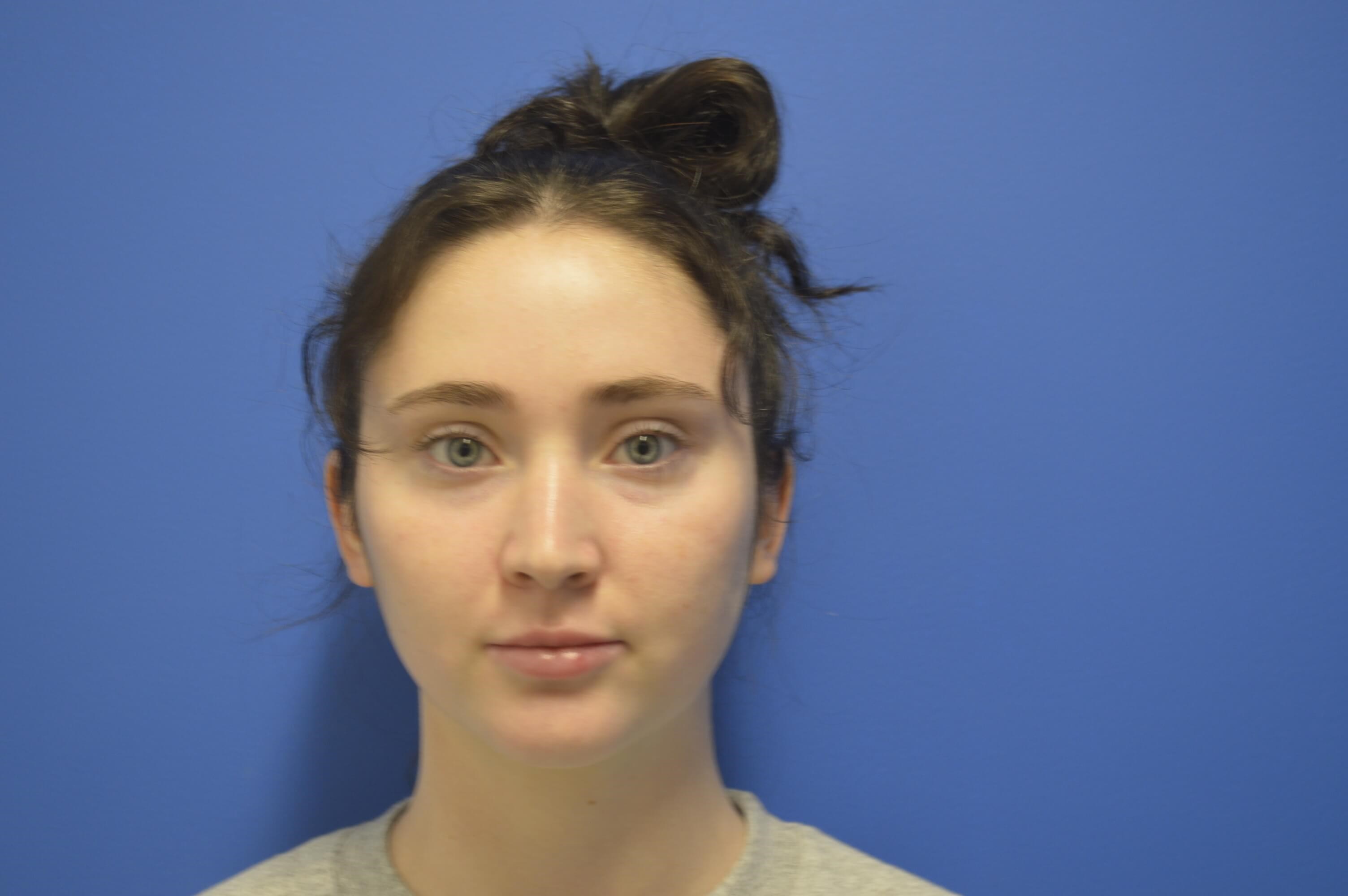 Closed rhinoplasty. Before