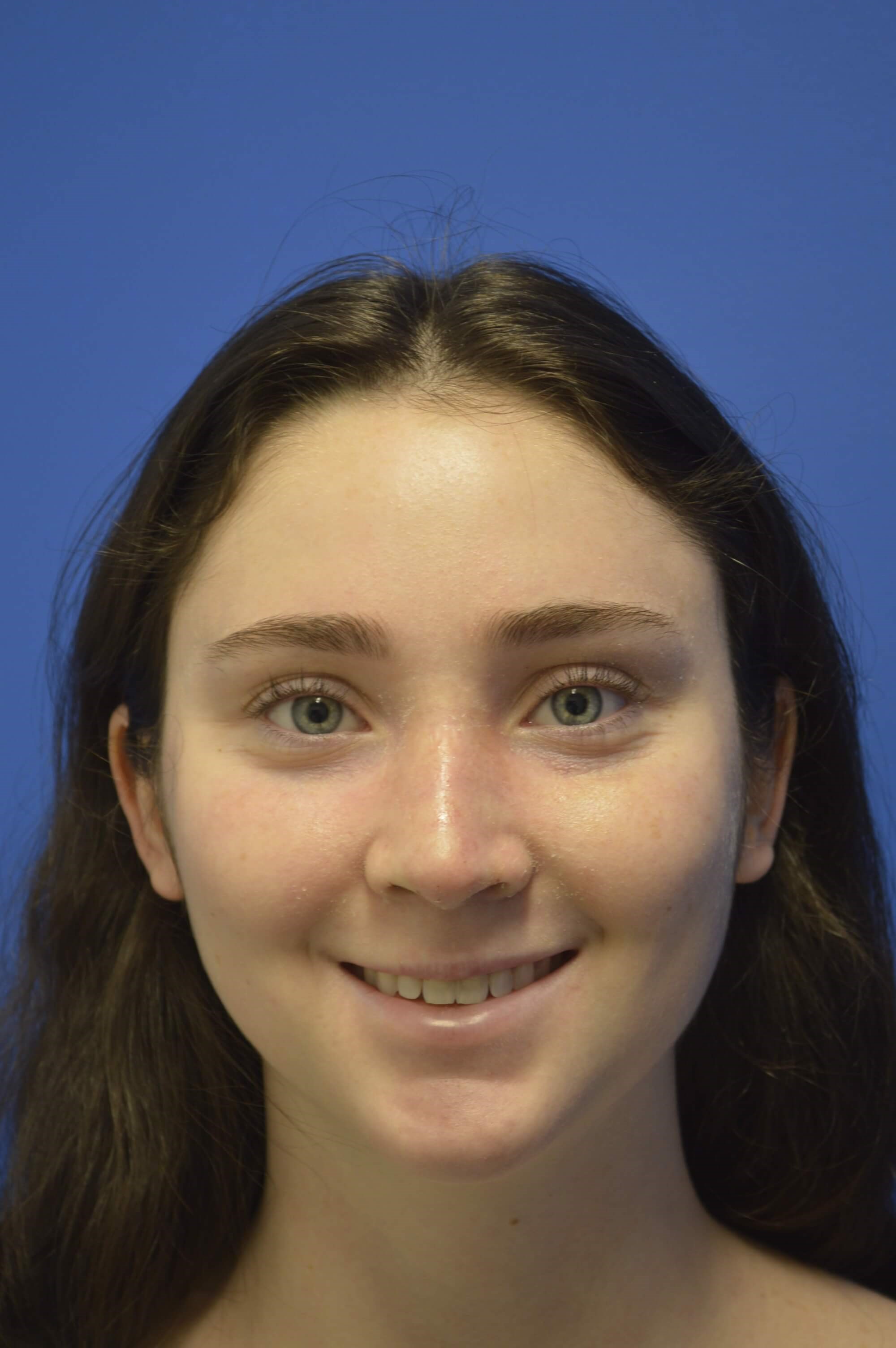 Closed rhinoplasty. After
