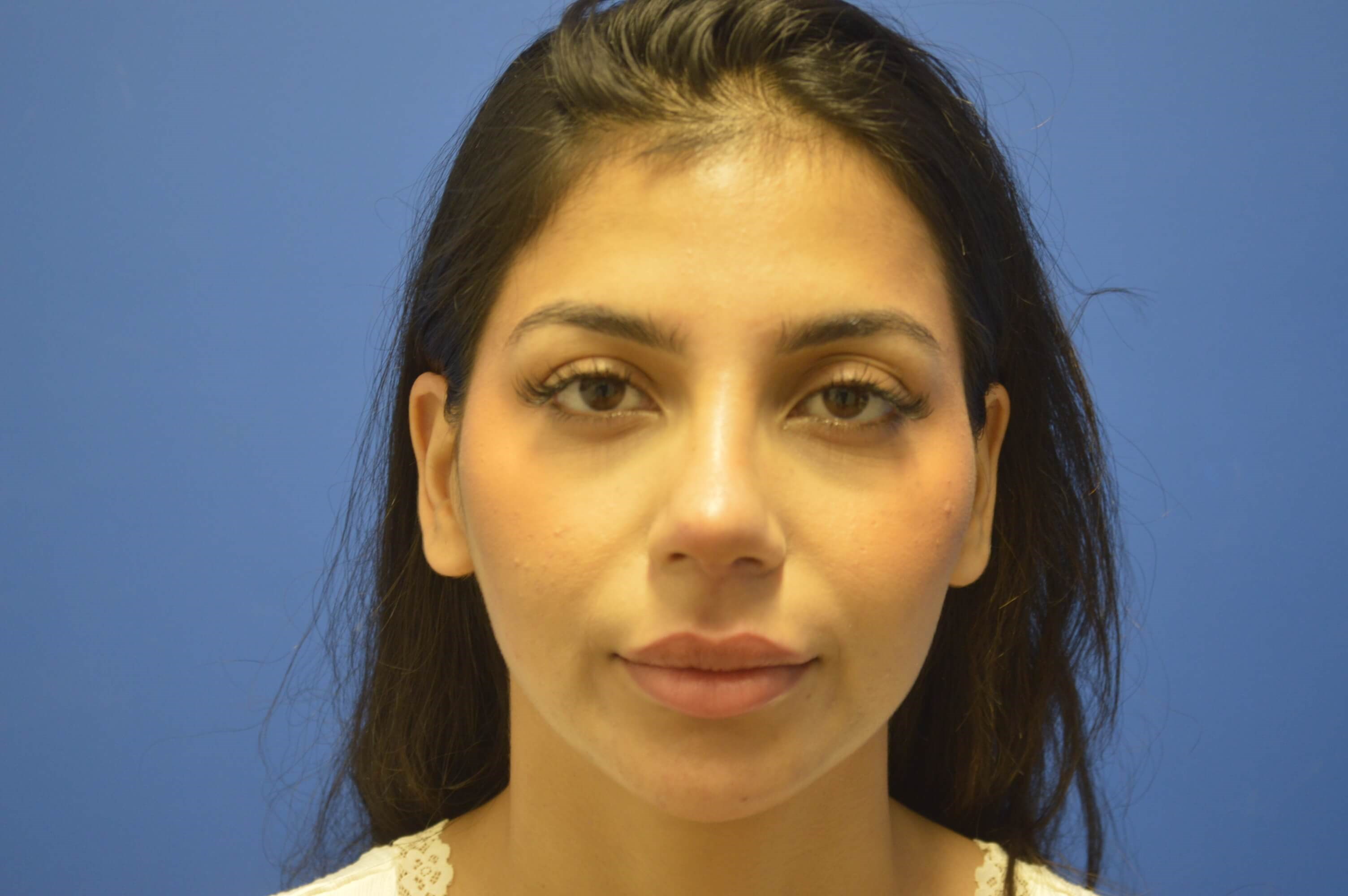 Middle Eastern Rhinoplasty After