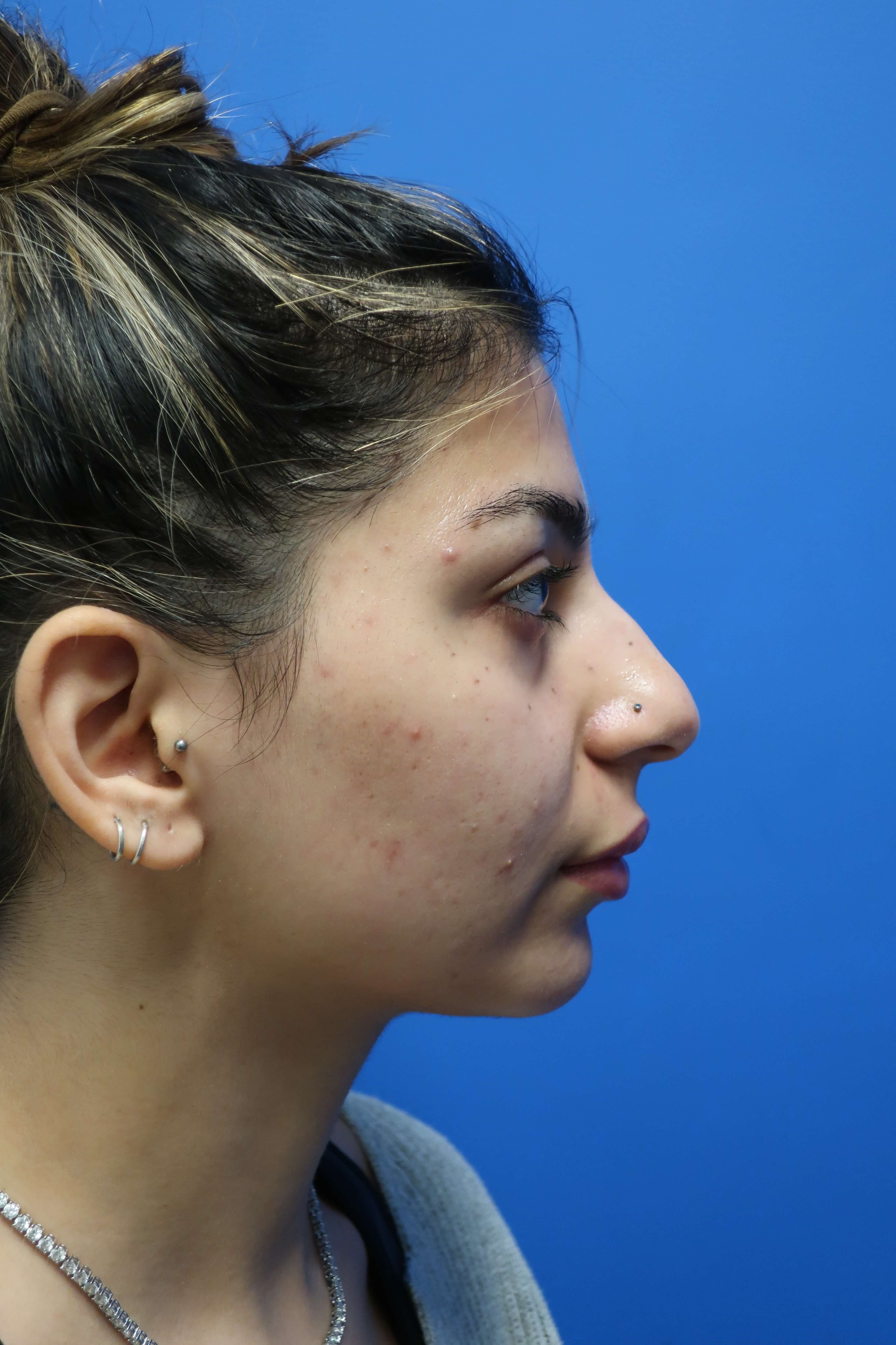 Open rhinoplasty Before