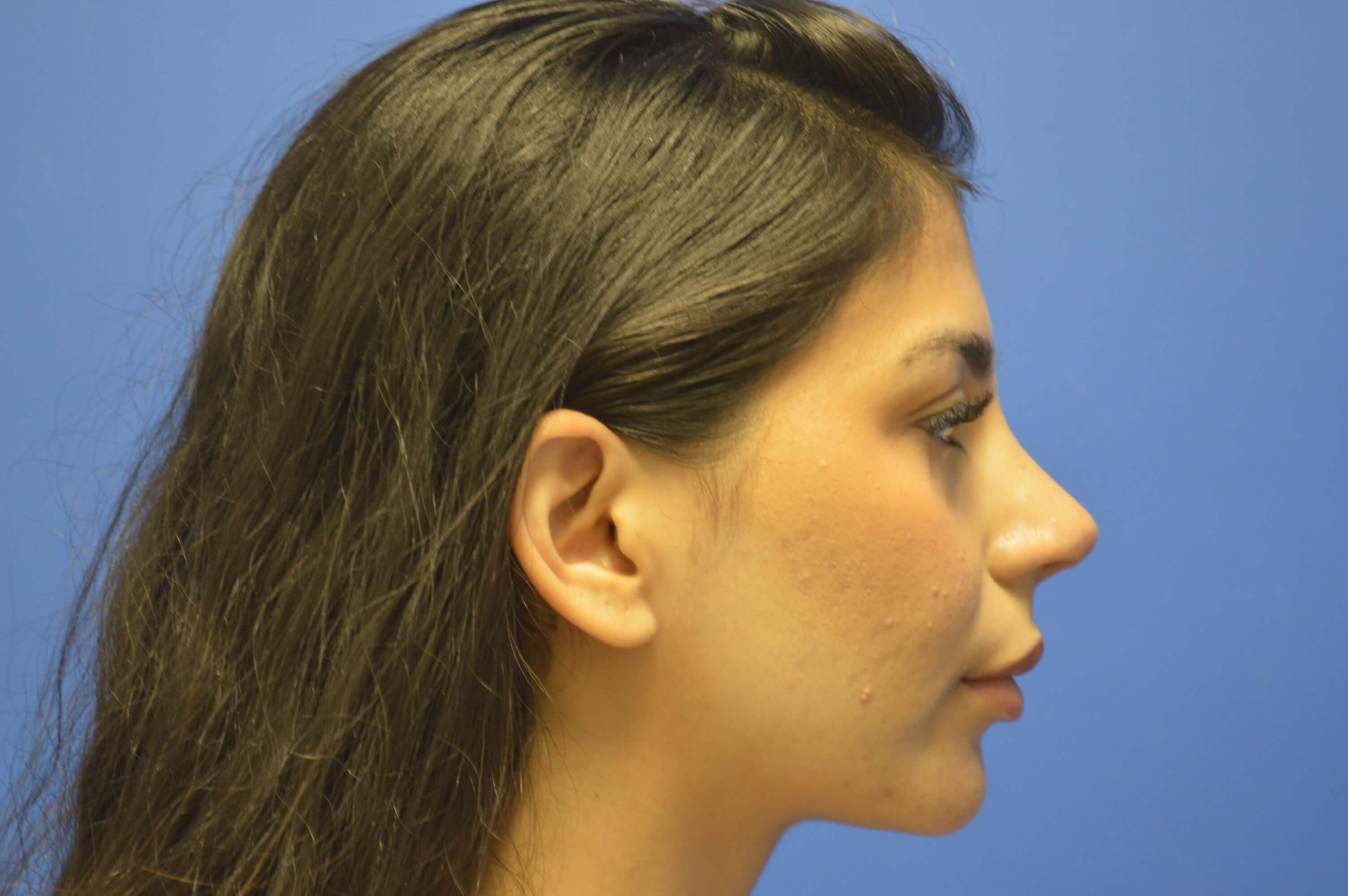 Open rhinoplasty After