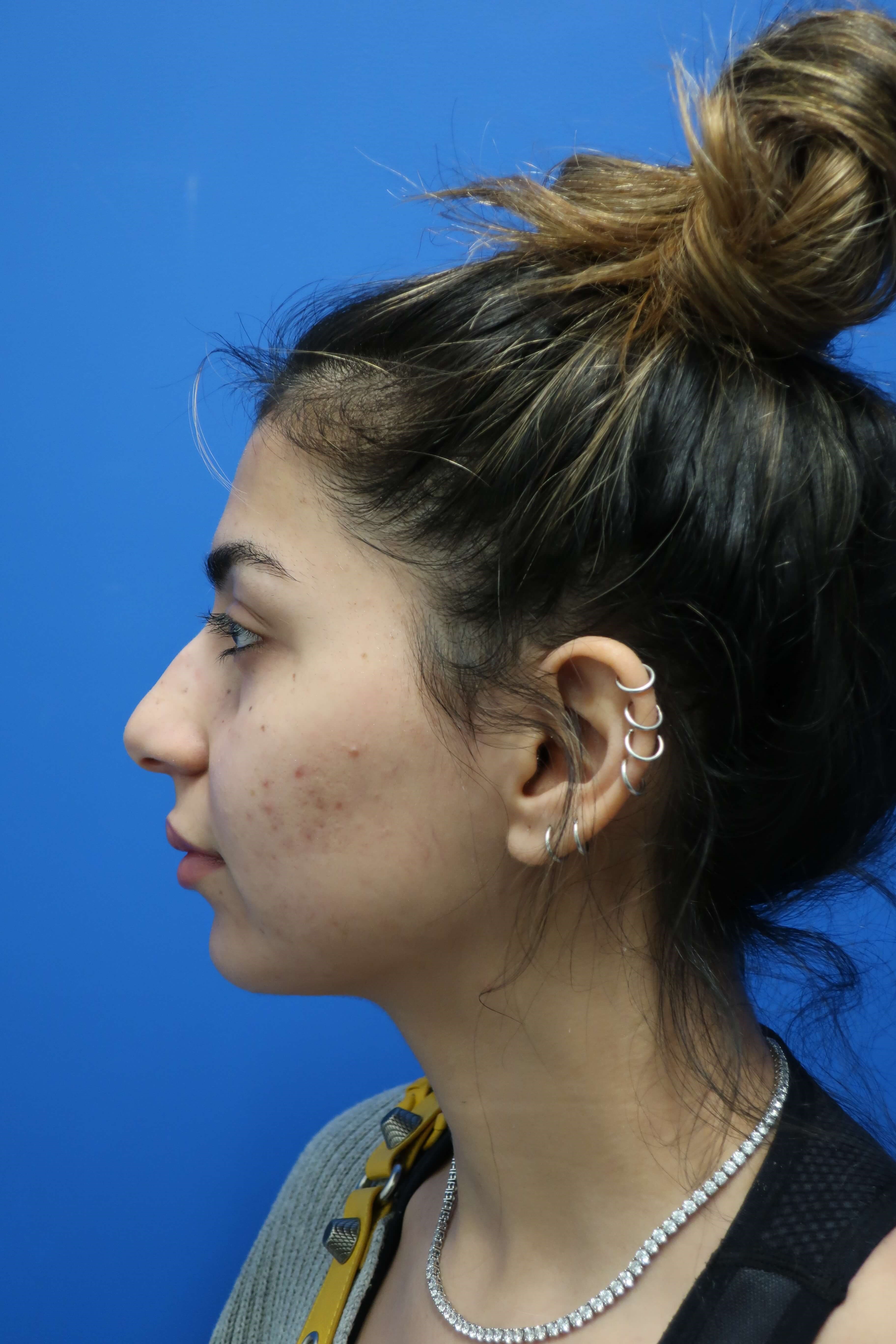 DC Rhinoplasty Before