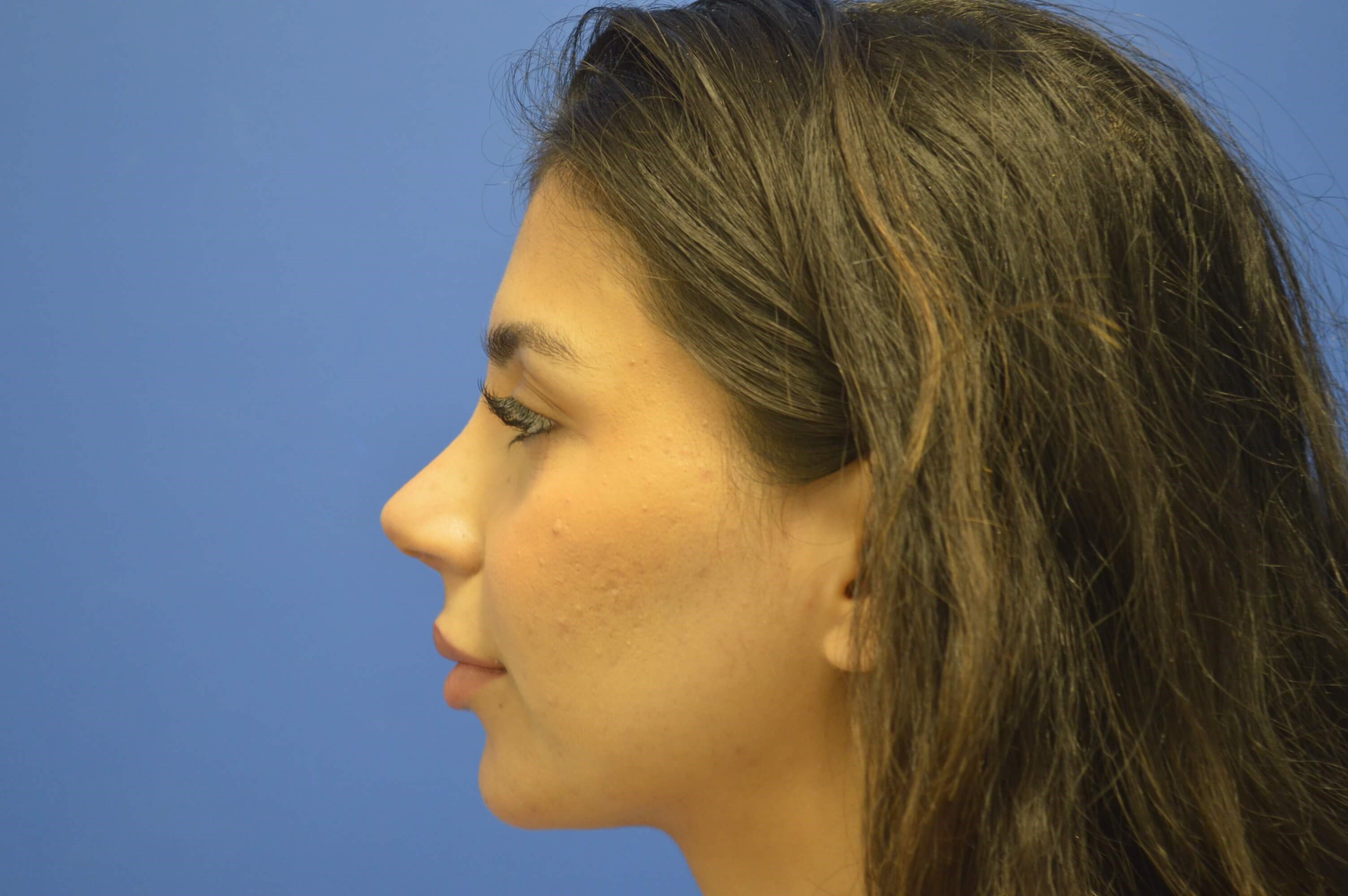 DC Rhinoplasty After