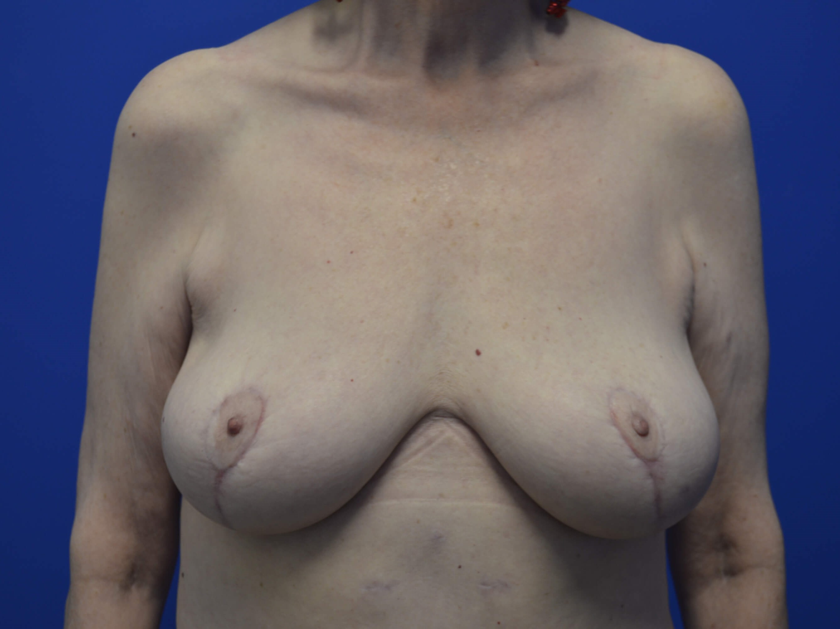 Staged Breast Lift & Implants Mastopexy - Front