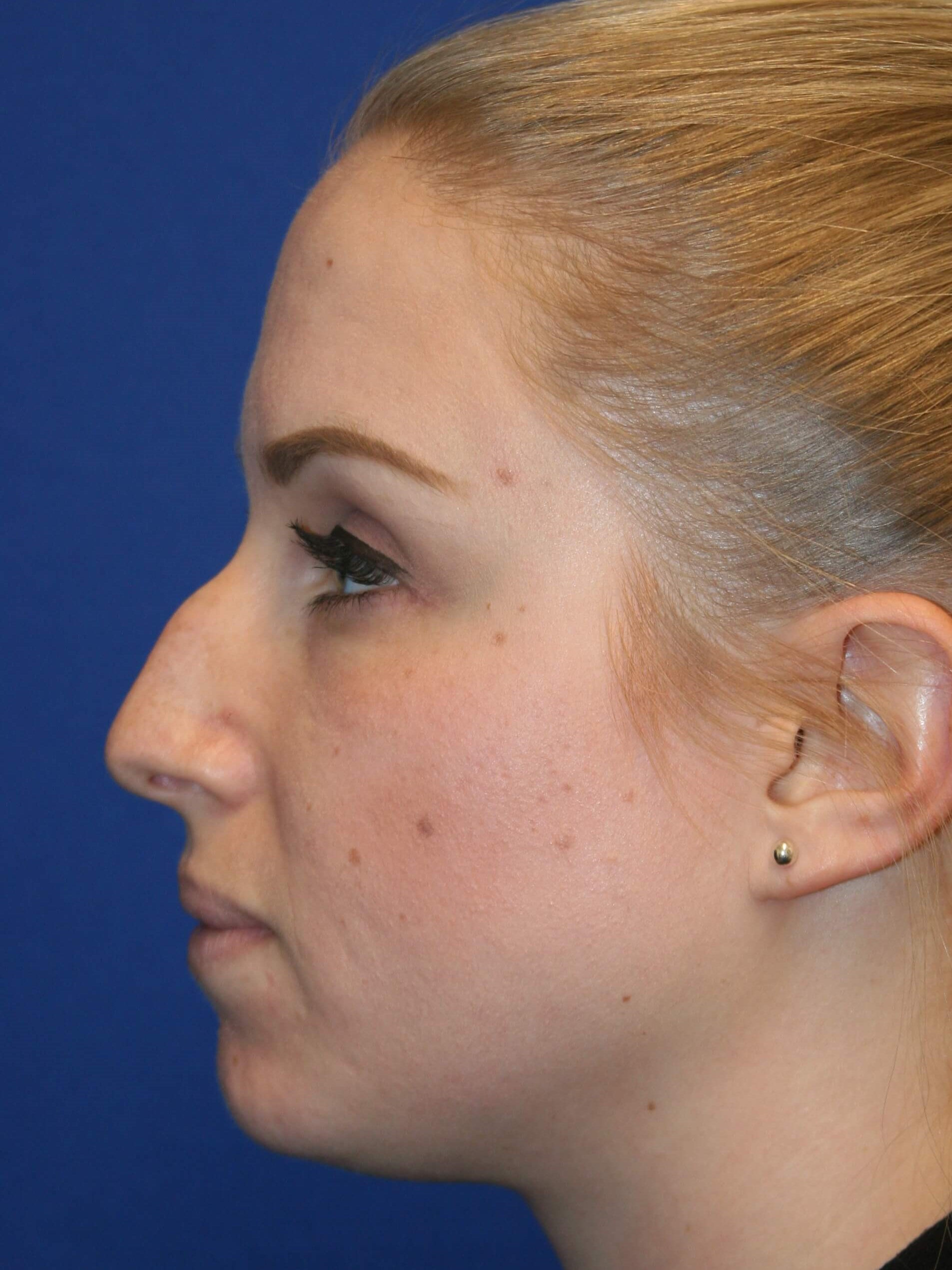 Rhinoplasty Before