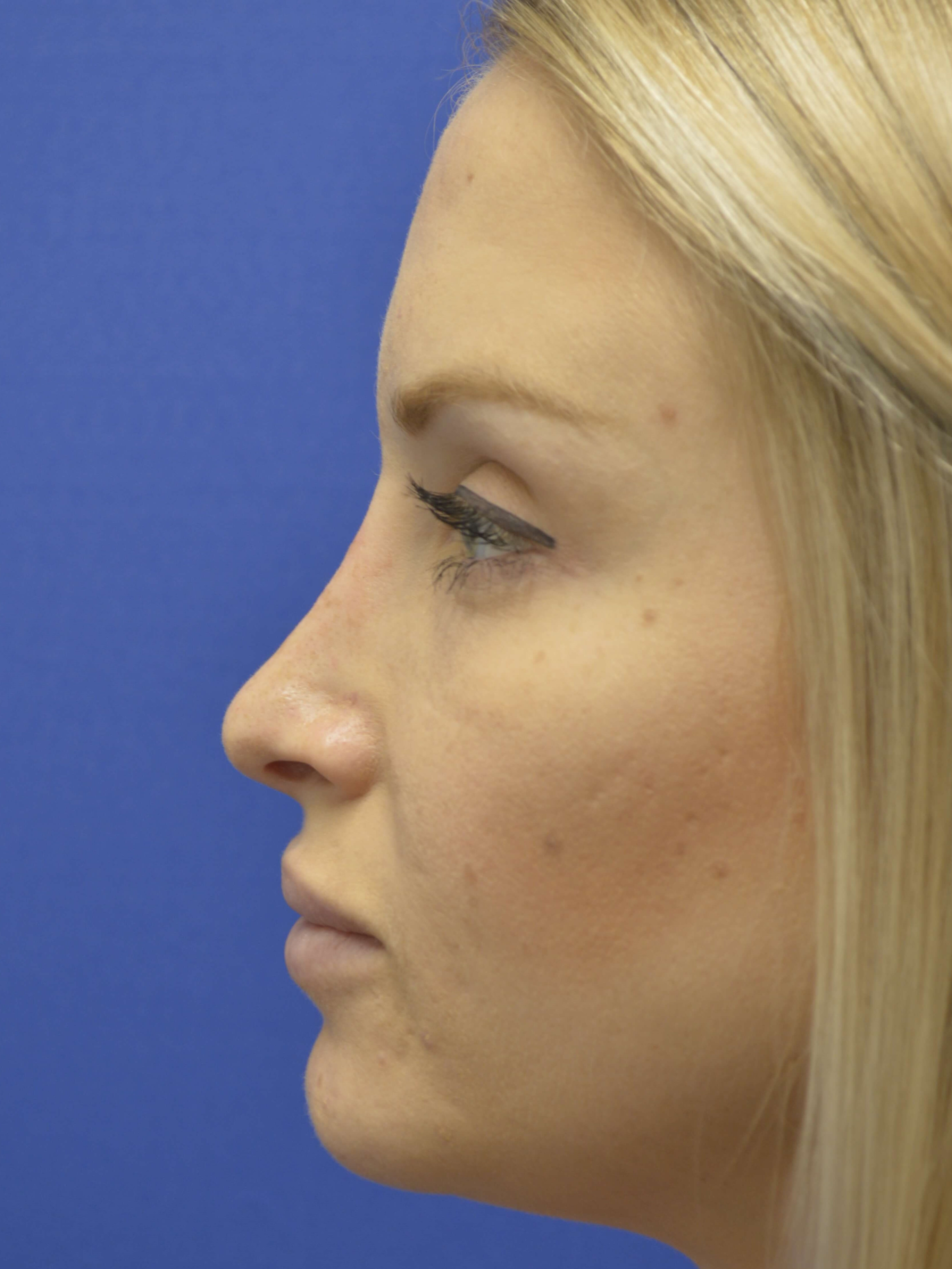 Rhinoplasty After