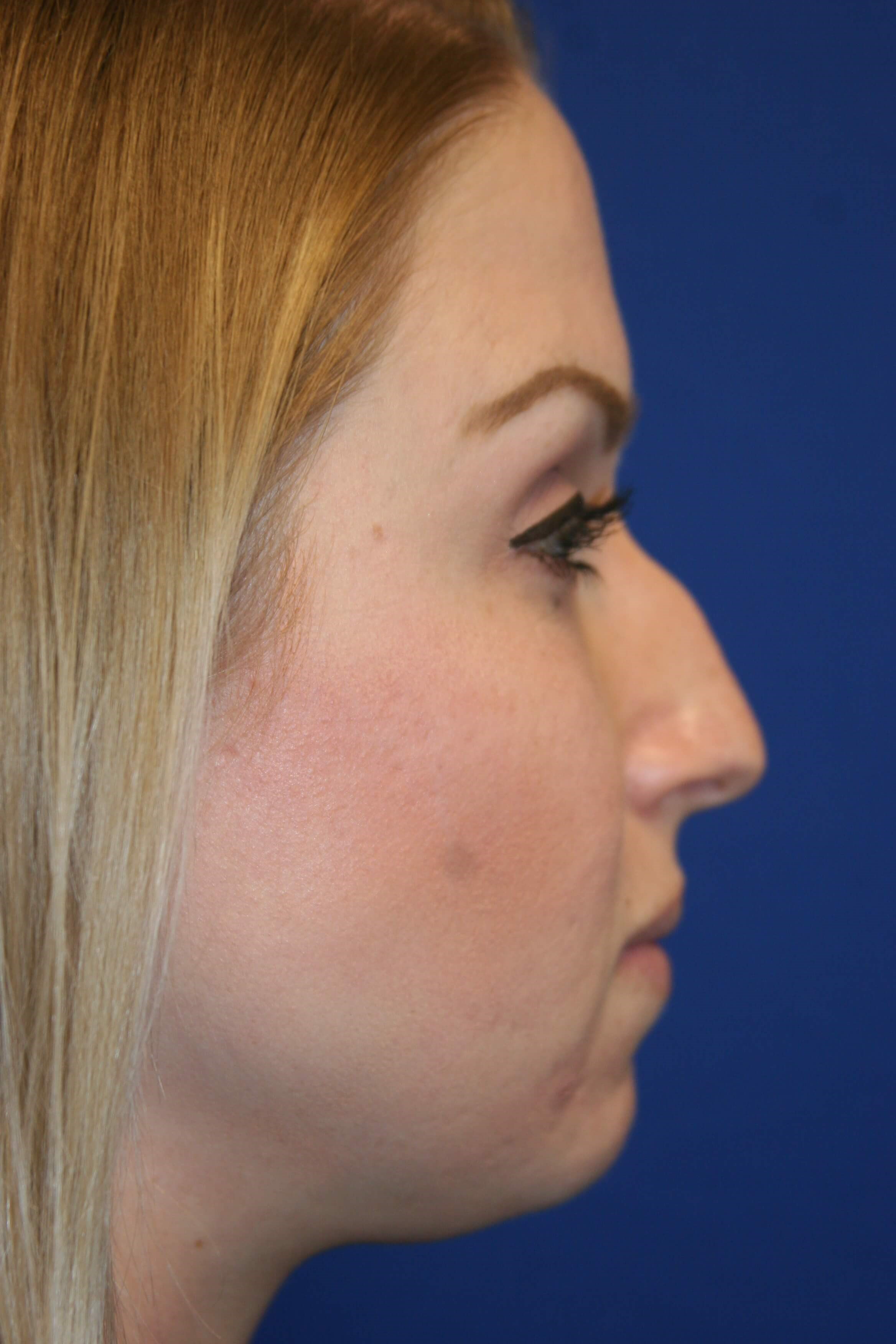 Rhinoplasty Before