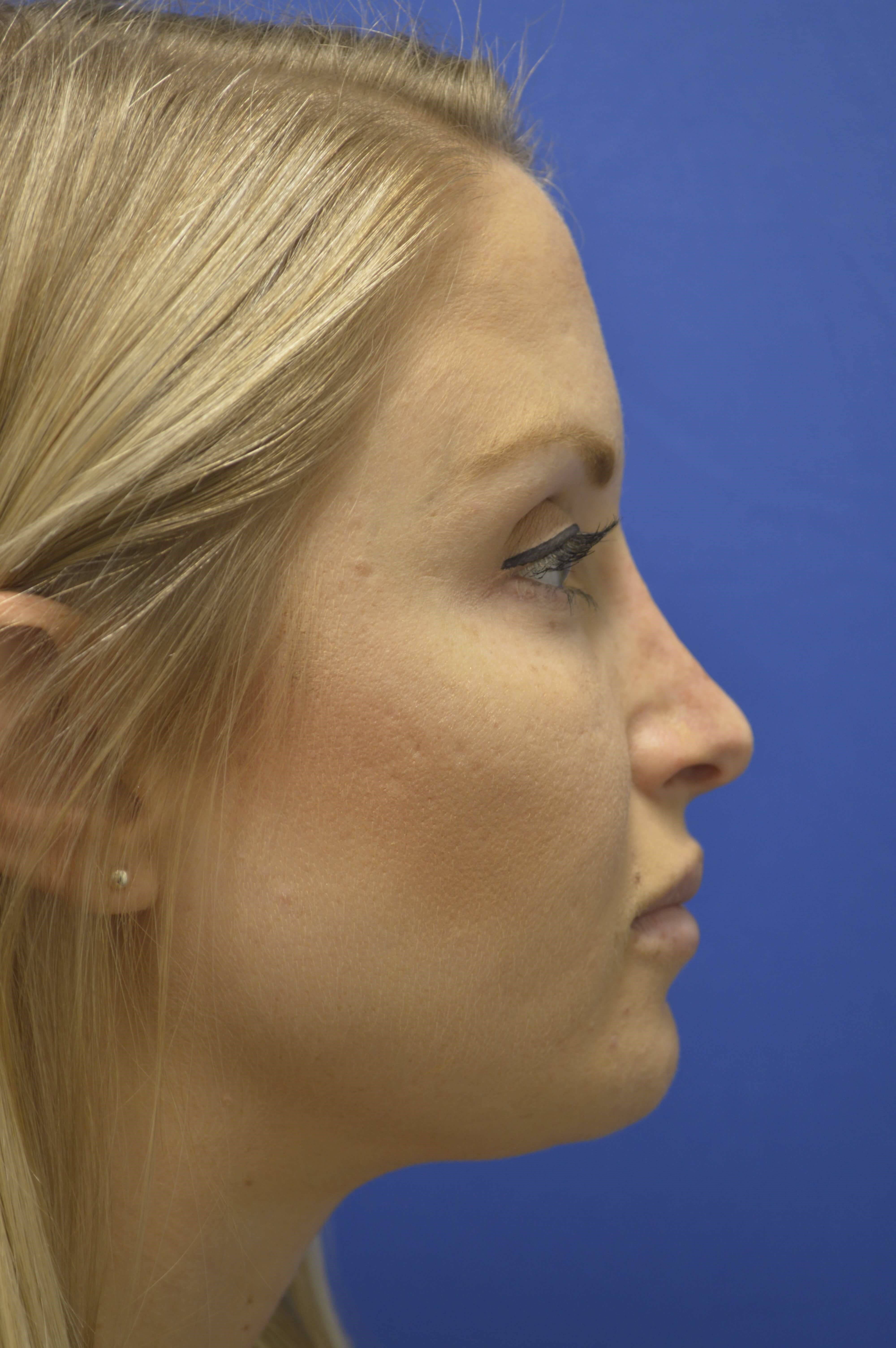 Rhinoplasty After