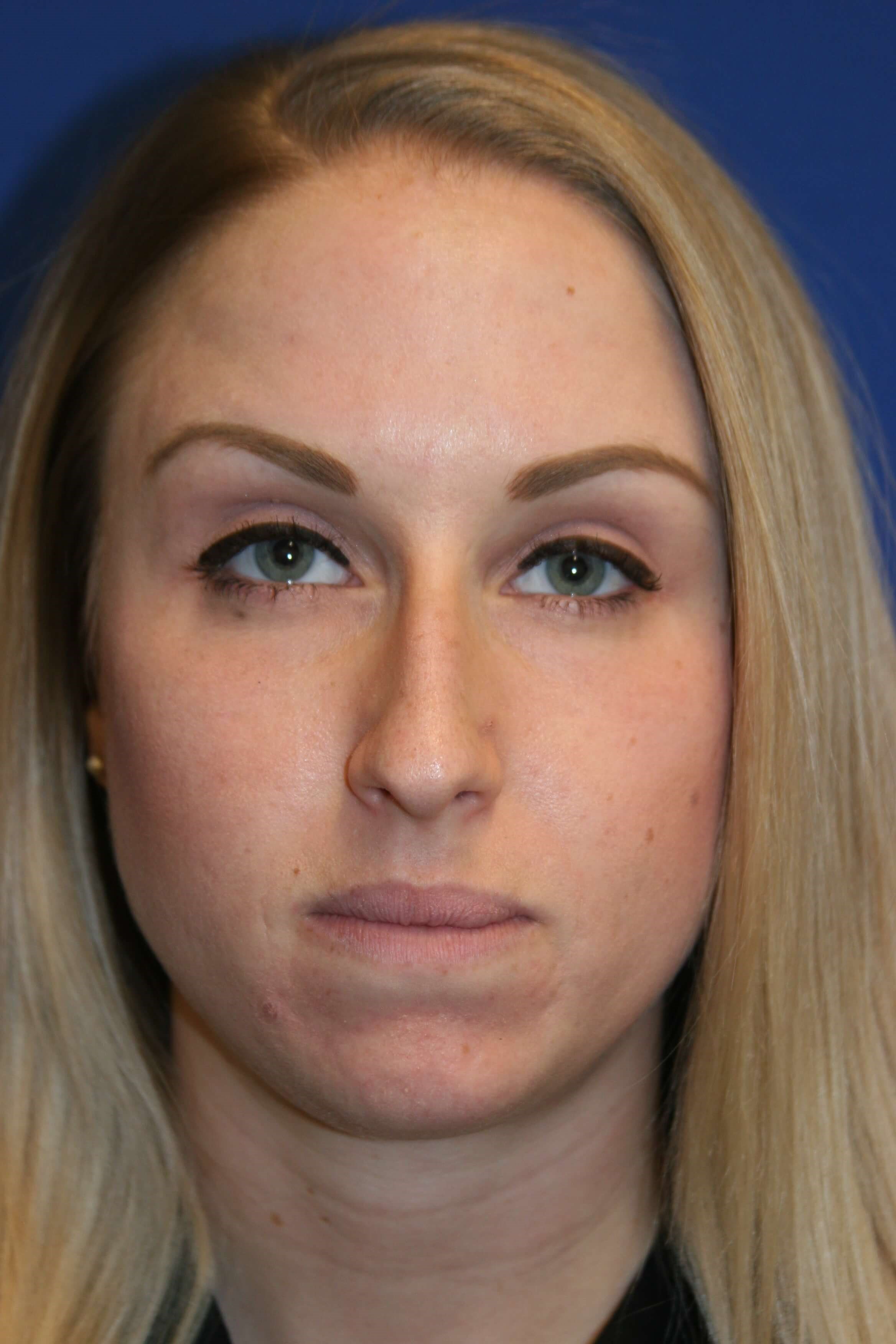 Rhinoplasty Before