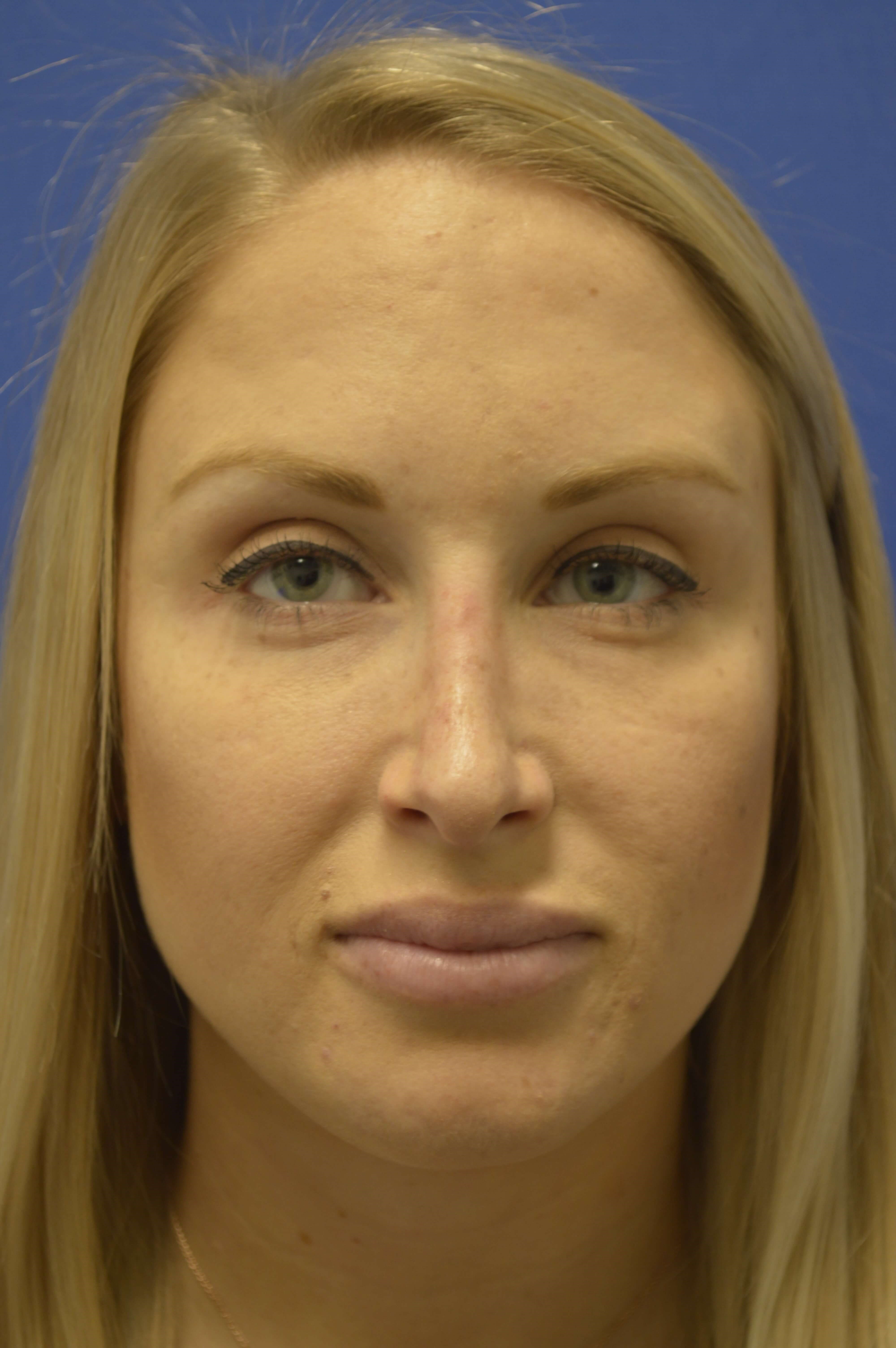 Rhinoplasty After