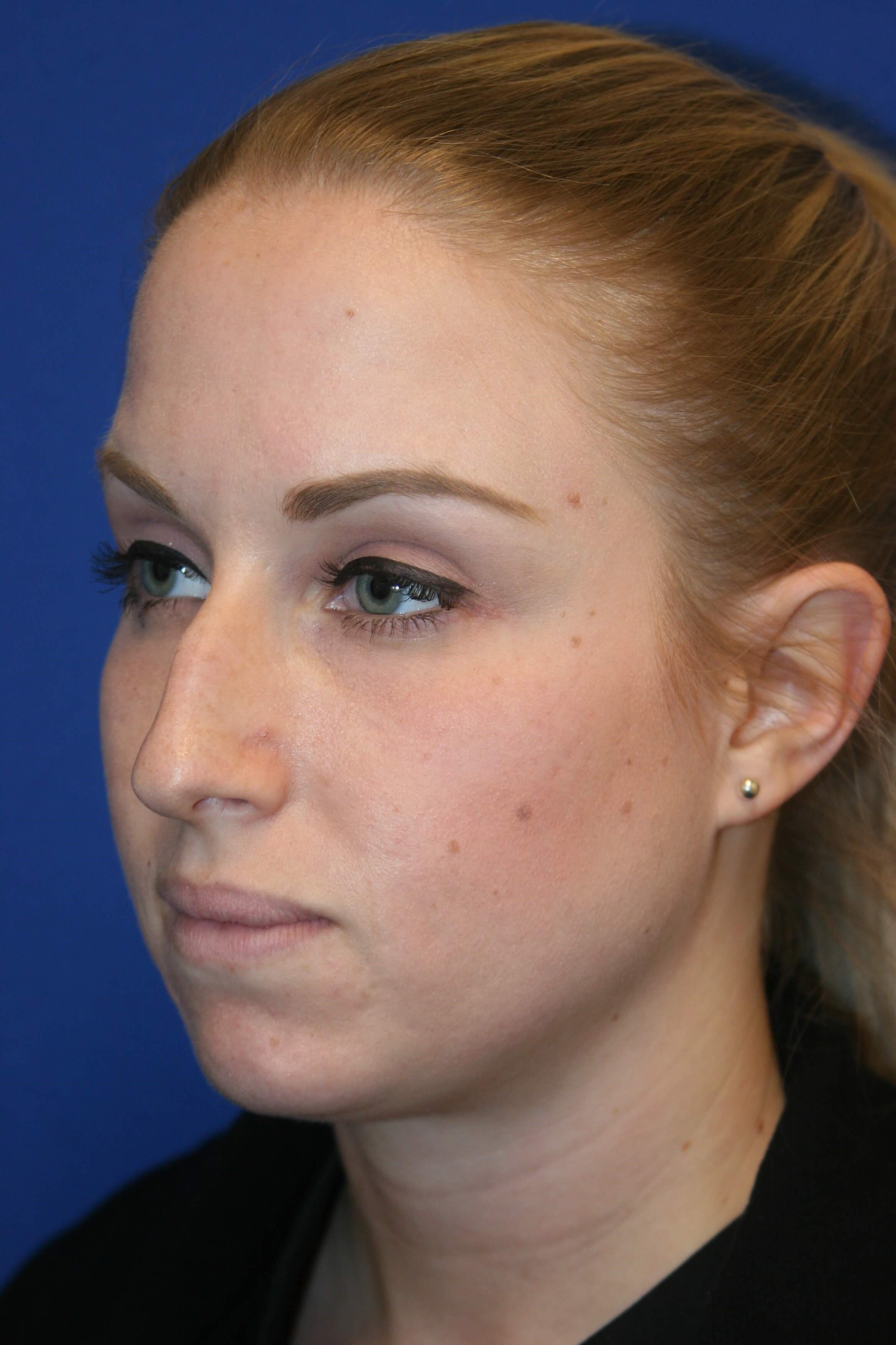 Rhinoplasty Before