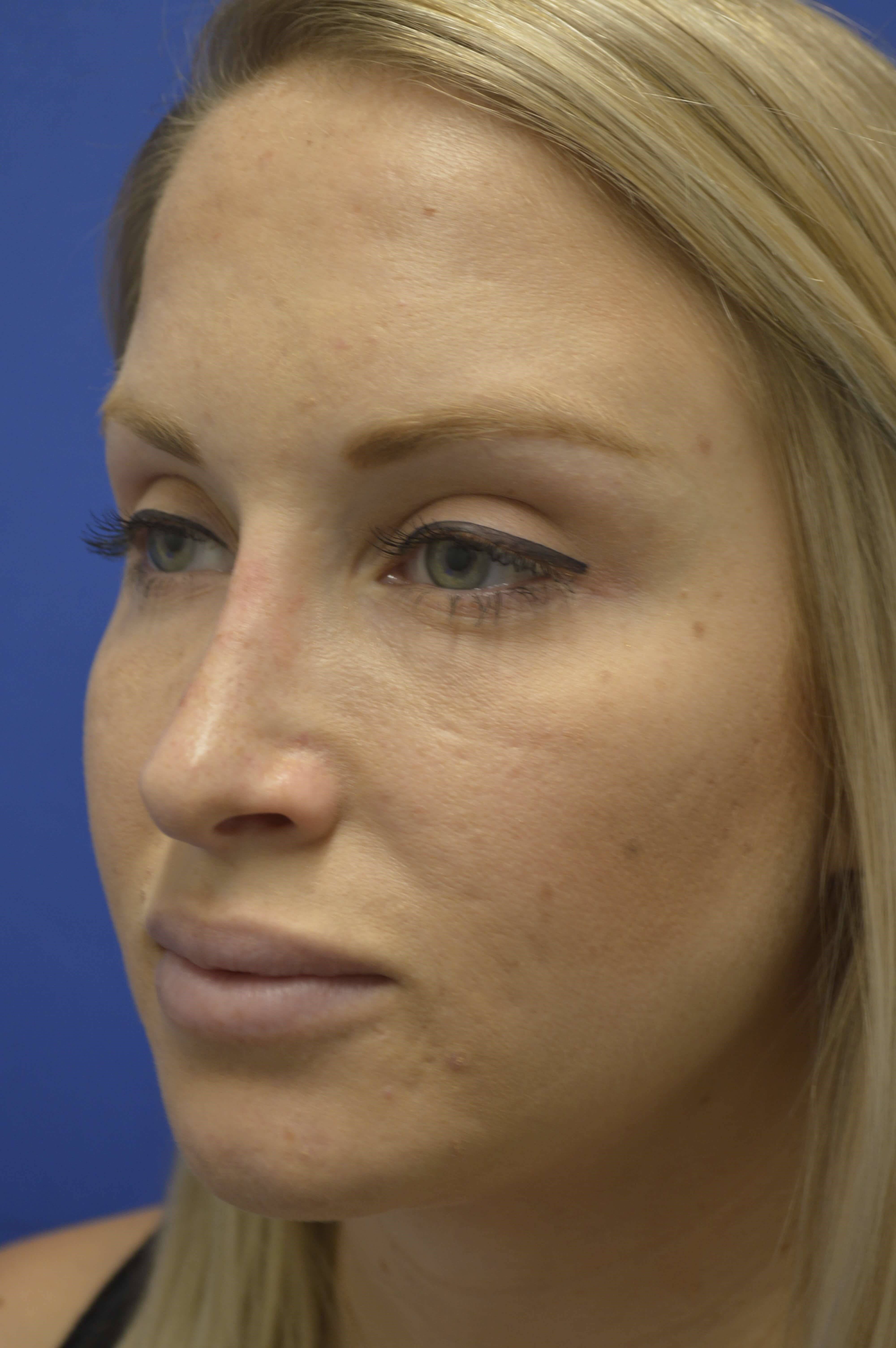 Rhinoplasty After