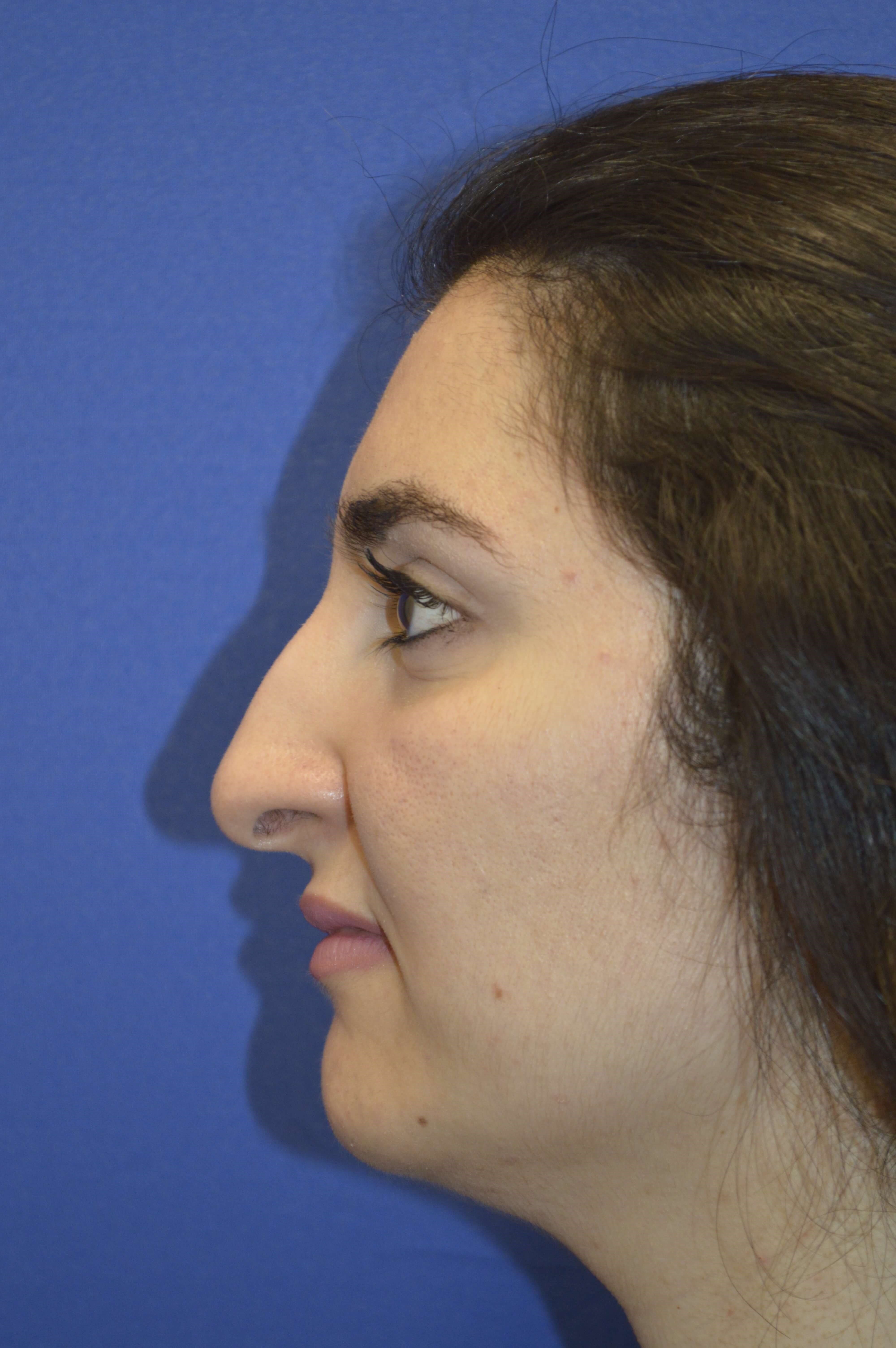 Rhinoplasty Washington DC Before- Profile